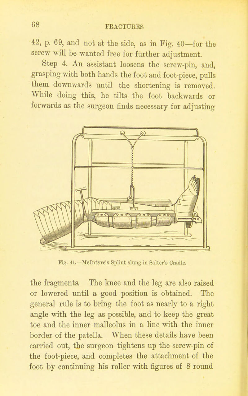 42, p. 69, and not at the side, as in Fig. 40—for the screw will be wanted free for further adjustment. Step 4. An assistant loosens the screw-pin, and, grasping with both hands the foot and foot-piece, pulls them downwards until the shortening is removed. While doing this, he tilts the foot backwards or forwards as the surgeon finds necessary for adjusting Fig. 41.—Mclntyre's Splint slung in Salter's Cradle. the fragments. The knee and the leg are also raised or lowered until a good position is obtained. The general rule is to bring the foot as nearly to a right angle with the leg as possible, and to keep the great toe and the inner malleolus in a line with the inner border of the patella. When these details have been carried out, the surgeon tightens up the screw-pin of the foot-piece, and completes the attachment of the foot by continuing his roller with figures of 8 round