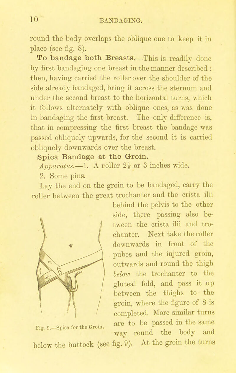 round the body overlaps the oblique one to keep it in place (see fig. 8). To bandage both Breasts.—This is readily done by first bandaging one breast in the manner described : then, having carried the roller over the shoulder of the side already bandaged, bring it across the sternum and under the second breast to the horizontal turns, -which it follows alternately with oblique ones, as was done in bandaging the first breast. The only difference is, that in compressing the first breast the bandage was passed obliquely upwards, for the second it is carried obliquely downwards over the breast. Spica Bandage at the Groin. Apparatus.—1. A roller 2| or 3 inches wide. 2. Some pins. Lay the end on the groin to be bandaged, carry the roller between the great trochanter and the crista ilii below the buttock (see fig. 9). At the groin the turns Fig. 0.—Spica for the Groin. behind the pelvis to the other side, there passing also be- tween the crista ilii and tro- chanter. Next take the roller downwards in front of the pubes and the injured groin, outwards and round the thigh below the trochanter to the gluteal fold, and pass it up between the thighs to the groin, where the figure of 8 is completed. More similar turns are to be passed in the same Avay round the body and