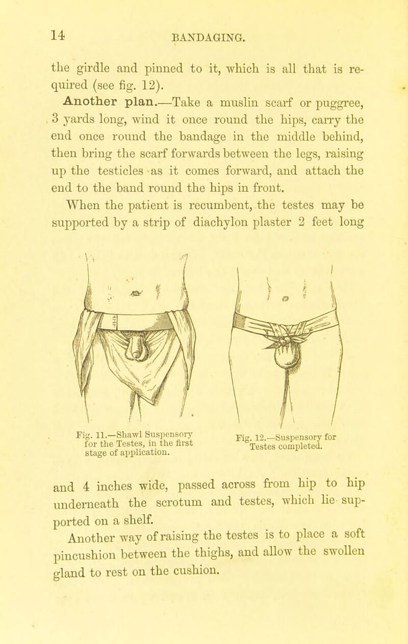 the girdle .and pinned to it, which is all that is re- quired (see fig. 12). Another plan.—Take a muslin scarf or puggree, 3 yards long, wind it once round the hips, carry the end once round the bandage in the middle behind, then bring the scarf forwards between the legs, raising up the testicles as it comes forward, and attach the end to the band round the hips in front. When the patient is recumbent, the testes may be supported by a strip of diachylon plaster 2 feet long Fig. 11.—Shawl Suspensory for the Testes, in the first stage of application. Fig. 12.—Suspensory for Testes completed. and 4 inches wide, passed across from hip to hip underneath the scrotum and testes, which lie sup- ported on a shelf. Another way of raising the testes is to place a soft pincushion between the thighs, and allow the swollen gland to rest on the cushion.