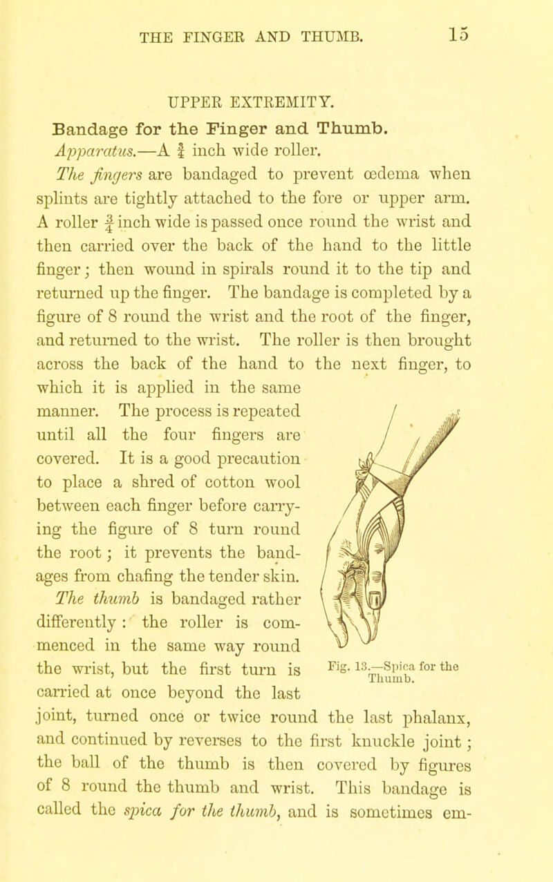 UPPER EXTREMITY. Bandage for the Finger and Thumb. Apparatus.—A f inch wide roller. The fingers are bandaged to prevent oedema when splints are tightly attached to the fore or upper arm. A roller f inch wide is passed once round the wrist and then carried over the back of the hand to the little finger; then wound in spirals round it to the tip and returned up the finger. The bandage is completed by a figure of 8 round the wrist and the root of the finger, and returned to the wrist. The roller is then brought across the back of the hand to the next finger, to which it is applied in the same manner. The process is repeated until all the four fingers are covered. It is a good precaution to place a shred of cotton wool between each finger before carry- ing the figure of 8 turn round the root; it prevents the band- ages from chafing the tender skin. The thumb is bandaged rather differently : the roller is com- menced in the same way round the wrist, but the first turn is Fis- 13^rs',i?a for the Thumb. carried at once beyond the last joint, turned once or twice round the last phalanx, and continued by reverses to the first knuckle joint; the ball of the thumb is then covered by figures of 8 round the thumb and wrist. This bandage is called the spica for the thumb, and is sometimes em-