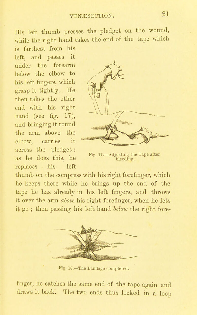 His left thumb presses the pledget on the wound, while the right hand takes the end of the tape which is farthest from his left, and passes it under the forearm below the elbow to his left fmgers, which grasp it tightly. He then takes the other end with his right hand (see fig. 17), and bringing it round the arm above the elbow, carries it across the pledget : as he does this, he replaces his left thumb on the compress with his right forefinger, which he keeps there while he brings up the end of the tape he has already in his left fingers, and throws it over the arm above his right forefinger, when he lets it go ; then passing his left hand beloiu the right fore- Fig. 17.—Adjusting the Tape after bleeding. Fig. 18.—The Bandage completed. finger, he catches the same end of the tape again and draws it back. The two ends thus locked in a loop