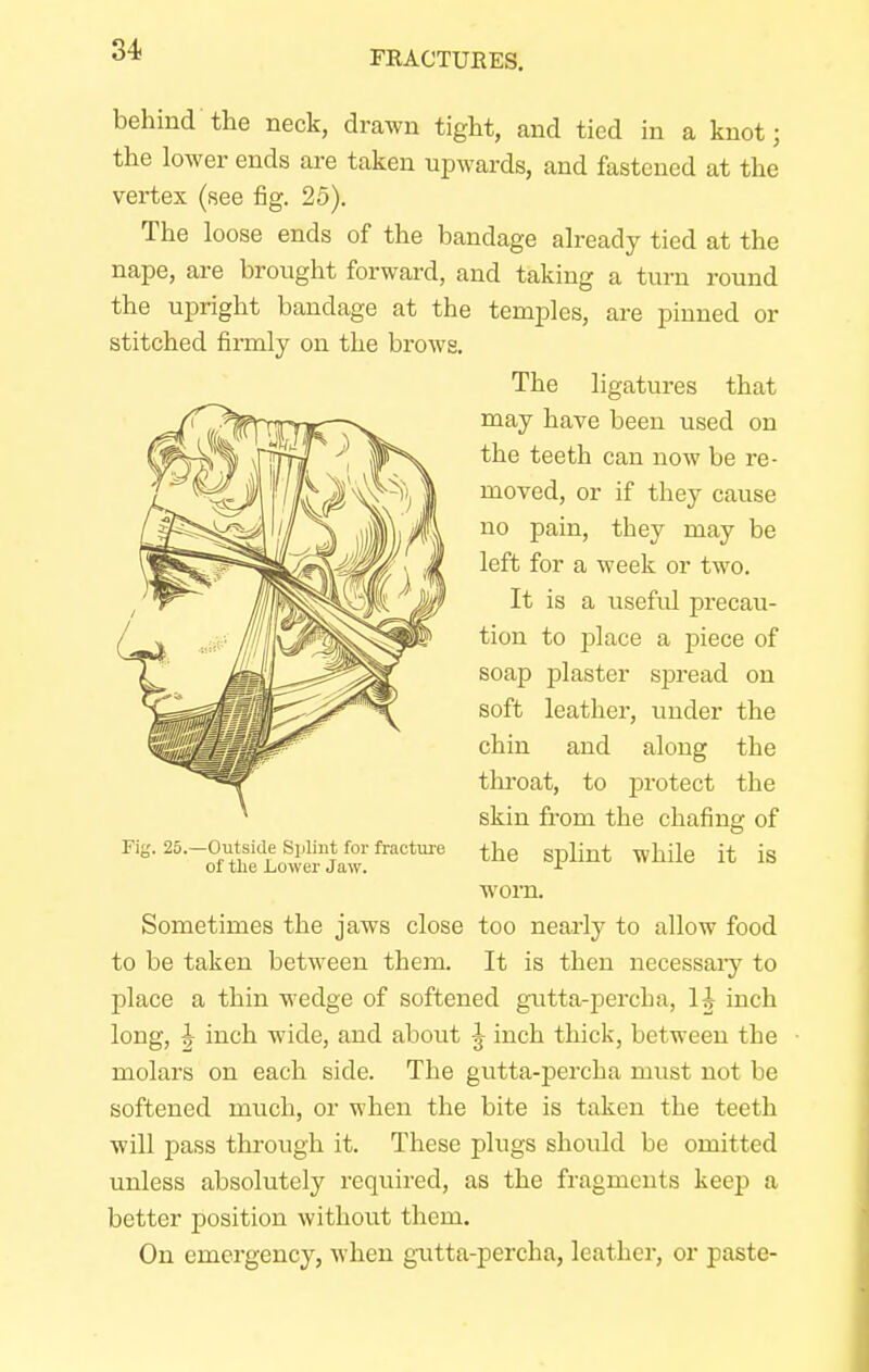 behind the neck, drawn tight, and tied in a knot; the lower ends are taken upwards, and fastened at the vertex (see fig. 25). The loose ends of the bandage already tied at the nape, are brought forward, and taking a turn round the upright bandage at the temples, are pinned or stitched firmly on the brows. The ligatures that may have been used on the teeth can now be re- moved, or if they cause no pain, they may be left for a week or two. It is a useful precau- / ■» I ti°n to jalace a piece of mM^^^^^^. soaP Poster spread on soft leather, under the chin and along the throat, to protect the skin from the chafing of the splint while it is worn. Sometimes the jaws close too nearly to allow food to be taken between them. It is then necessary to place a thin wedge of softened gutta-percha, H inch long, ^ inch wide, and about J inch thick, between the molars on each side. The gutta-percha must not be softened much, or when the bite is taken the teeth will pass through it. These plugs should be omitted unless absolutely required, as the fragments keep a better position without them. On emergency, when gutta-percha, leather, or paste- Fig. 25. -Outside Splint for fracture of the Lower Jaw.