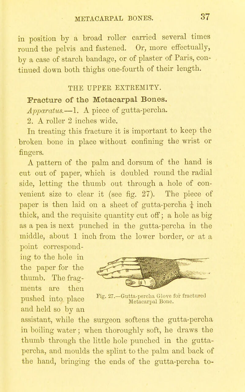 METACAEPAL BONES. in position by a broad roller carried several times round the pelvis and fastened. Or, more effectually, by a case of starch bandage, or of plaster of Paris, con- tinued down both thighs one-fourth of their length. THE UPPER EXTREMITY. Fracture of the Metacarpal Bones. Apparatus.—1. A piece of gutta-percha. 2. A roller 2 inches wide. In treating this fracture it is important to keep the broken bone in place without confining the wrist or fingers. A pattern of the palm and dorsum of the hand is cut out of paper, which is doubled round the radial side, letting the thumb out through a hole of con- venient size to clear it (see fig. 27). The piece of paper is then laid on a sheet of gutta-percha i inch thick, and the requisite quantity cut off; a hole as big as a pea is next punched in the gutta-percha in the middle, about 1 inch from the lower border, or at a point correspond- ing to the hole in the paper for the thumb. The frag- ments are then pushed into place »* ^^^^ M' hM and held so by an assistant, while the surgeon softens the gutta-percha in boiling water; when thoroughly soft, he draws the thumb through the little hole punched in the gutta- percha, and moulds the splint to the palm and back of the hand, bringing the ends of the gutta-percha to-