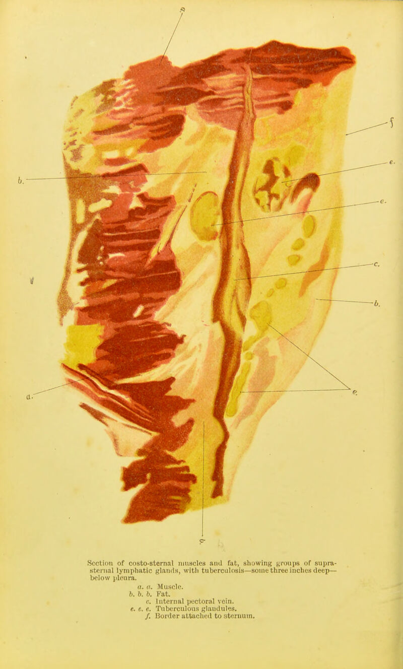 Section of costo-sternal iiiiiaclcs and fat, showing grou])s of supra- sternal lymphatic glands, with tuberculosis—some three inches deep— below pleura. a. (I. Muscle. b. h. b. Fat. e. Internal pectoral vein. e. e. e. Tuberculous glandules. /. Border attached to sternum.