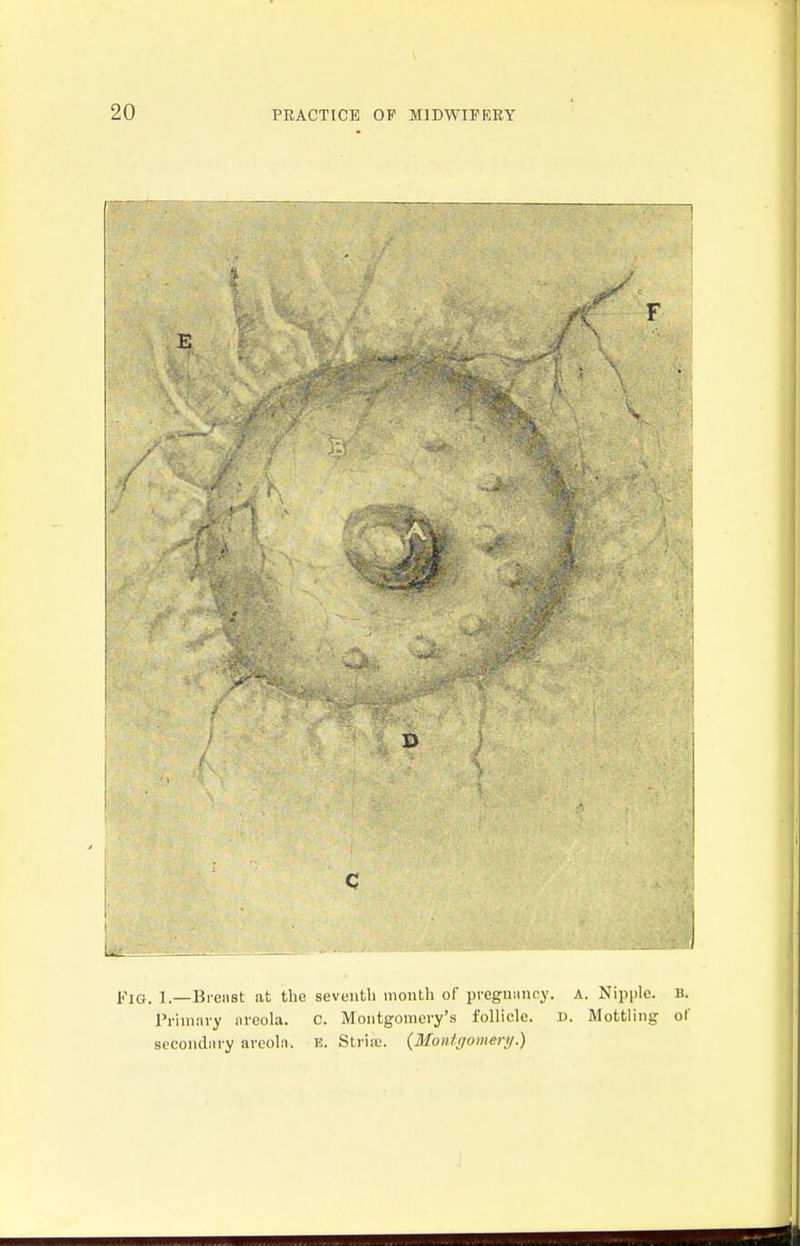 Fig. 1.—Bi-eiist at the seventh month of pveguiincy. a. Nipple, b. Primiiry nreola. C. Montgomery's follicle. D. Mottling of secondiiry areoln. E. Striiu. {Monlgoinery.)