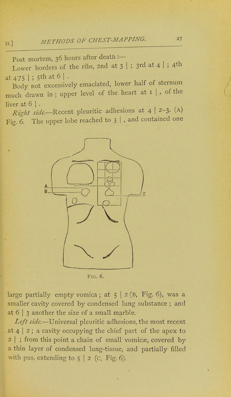 Post mortem, 36 hours after death :— Lower borders of the ribs, 2nd at 3 | ; S^d at 4 h 4th at 475 1 ; 5th at 6 | . Body not excessively emaciated, lower half of sternum much drawn in ; upper level of the heart at i | , of the liver at 6 I . Right .rz^fe—Recent pleuritic adhesions at 4 | 2-3. (A) Fig. 6. The upper lobe reached to 3 I , and contained one Fig. 6. large partially empty vomica ; at 5 | 2 (b, Fig. 6), was a smaller cavity covered by condensed lung substance ; and at 6 I 3 another the size of a small marble. Left side.—Universal pleuritic adhesions, the most recent at 4 I 2 ; a cavity occupying the chief part of the apex to 2 I ; from this point a chain of small vomicae, covered by a thin layer of condensed lung-tissue, and partially filled with pus, extending to 5 | 2 (c, Fig. 6).