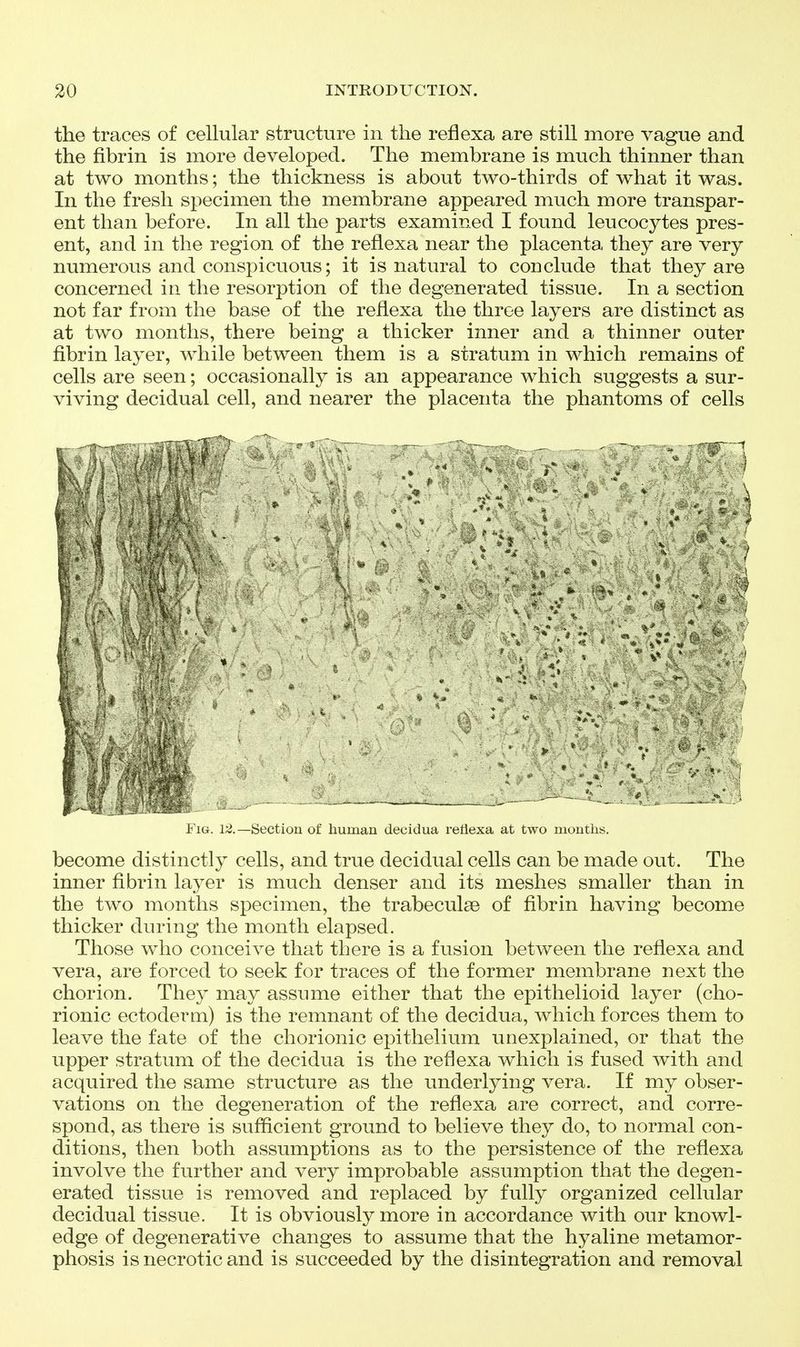 the traces of cellular structure in the reflexa are still more vague and the fibrin is more developed. The membrane is much thinner than at two months; the thickness is about two-thirds of what it was. In the fresh specimen the membrane appeared much more transpar- ent than before. In all the parts examined I found leucocytes pres- ent, and in the region of the reflexa near the placenta they are very numerous and conspicuous; it is natural to conclude that they are concerned in the resorption of the degenerated tissue. In a section not far from the base of the reflexa the throe layers are distinct as at two months, there being a thicker inner and a thinner outer fibrin layer, while between them is a stratum in which remains of cells are seen; occasionally is an appearance which suggests a sur- viving decidual cell, and nearer the placenta the phantoms of cells become distinctly cells, and true decidual cells can be made out. The inner fibrin layer is much denser and its meshes smaller than in the two months specimen, the trabeculse of fibrin having become thicker during the month elapsed. Those who conceive that there is a fusion between the reflexa and vera, are forced to seek for traces of the former membrane next the chorion. They may assume either that the epithelioid layer (cho- rionic ectoderm) is the remnant of the decidua, which forces them to leave the fate of the chorionic epithelium unexplained, or that the upper stratum of the decidua is the reflexa which is fused with and acquired the same structure as the underlying vera. If my obser- vations on the degeneration of the reflexa are correct, and corre- spond, as there is sufficient ground to believe they do, to normal con- ditions, then both assumptions as to the persistence of the reflexa involve the further and very improbable assumption that the degen- erated tissue is removed and replaced by fully organized cellular decidual tissue. It is obviously more in accordance with our knowl- edge of degenerative changes to assume that the hyaline metamor- phosis is necrotic and is succeeded by the disintegration and removal -■ i I Fig. Sectiou of liumau decidua reflexa at two uioutiis.