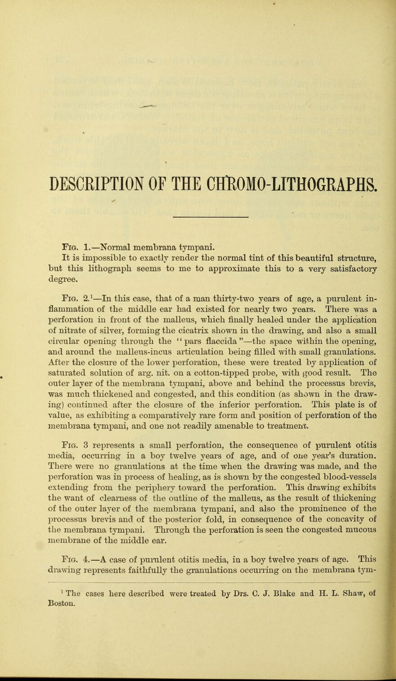 DESCRIPTION OF THE CHllOMO-LITHOGRAPflS. Fig. 1.—Normal membrana tympani. It is impossible to exactly render the normal tint of this beautiful structure, but this lithograph seems to me to approximate this to a very satisfactory degree. Fig. 2.'—In this case, that of a man thirty-two years of age, a purulent in- flammation of the middle ear had existed for nearly two years. There was a perforation in front of the malleus, which finally healed under the application of nitrate of silver, forming the cicatrix shown in the drawing, and also a small circular opening through the '' pars flaccida —the space within the opening, and around the malleus-incus articulation being filled with small granulations. After the closure of the lower perforation, these Avere treated by application of saturated solution of arg. nit. on a cotton-tipped probe, with good result. The outer layer of the membrana tympani, above and behind the processus brevis, was much thickened and congested, and this condition (as shown in the draw- ing) continued after tlie closure of the inferior perforation. This plate is of value, as exhibiting a comparatively rare form and position of perforation of the membrana tympani, and one not readily amenable to treatment. Fig. 3 represents a small perforation, the consequence of purulent otitis media, occurring in a boy twelve years of age, and of one year's duration. There were no granulations at the time when the drawing was made, and the perforation was in j)rocess of healing, as is shown by the congested blood-vessels extending from the periphery toward the perforation. This drawing exhibits the want of clearness of the outline of the malleus, as the result of thickening of the outer layer of the membrana tympani, and also the prominence of the processus brevis and of the posterior fold, in consequence of the concavity of the membrana tympani. Through the perforation is seen the congested mucous membrane of the middle ear. Fig. 4.—A case of purulent otitis media, in a boy twelve years of age. This drawing represents faithfully the granulations occurring on the membrana tym- ^ The cases here described were treated by Drs. C. J. Blake and H. L. Shaw, of Boston.