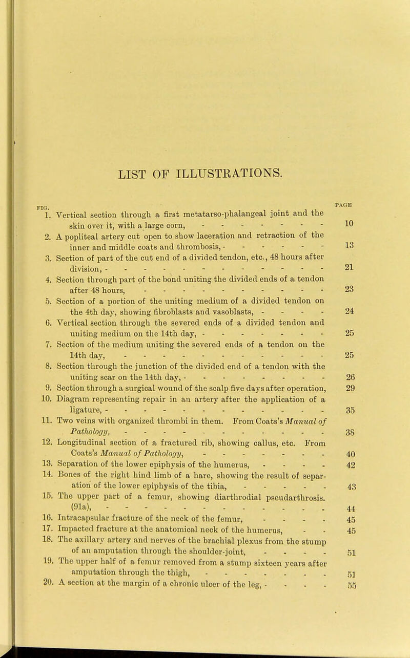 LIST OF ILLUSTRATIONS. FIG. 1 1. Verticaii sccuion tnrougQ £i iirsu ineTid(Uciiou-pud»iciugcapi jumu anu, PAGE skin over it, with, a large corn, 10 o Z, ii. poplitearl QjVZQcy cuti open to squw idccrduiuii chill leLrioiuuiuii k*l uuc 13 inner and middle coats and thrombosis, ------ o o. oecuion 01 part oi me cuu enu oi a uiviutju. icuuuuj eu^*., to uuuia aLuci 21 4. oection turougn part pi tne Donu, uniting tue ciivicicti eucis oi d iciiuun after 48 hours, - 23 0. oectiOu or ai portion ox tne uniting meuium oi a uiviucu. teuuuii uii the 4th day, showing fibroblasts and vasoblasts, - - - - b. Vertical section through the severed ends of a divided tendon and uniting medium on the 14th day, ------- 7 1. Section of the medium uniting the severed ends of a tendon oil the Q Of occwou turougii tue junction oi tne uivjiieu. enu. oi a uenuou wiuu tue 9. Section thrmiofh a, snrcifia.] woimfl of thp ^p.a.lii fivp dft.vs nf hpr nnprntinn 29 10. Diagram representing repair in an artery after the apjplication of a 35 11. Two veins with organized thrombi in them. From Coats's Manual of 38 12. Longitudinal section of a fractured rib, showing callus, etc. From Coats's Manual of Pathology, - 40 13. Separation of the lower epiphysis of the humerus, .... 42 14. Bones of the right hind limb of a hare, showing the result of separ- ation of the lower epiphysis of the tibia, 43 15. The upper part of a femur, showing diarthrodial pseudarthrosis. (91a), 44 16. Intracapsular fracture of the neck of the femur, .... 45 17. Impacted fracture at the anatomical neck of the humerus. 45 18. The axillary artery and nerves of the brachial plexus from the stump of an amputation tlirough the shoulder-joint, .... 51 19. The upper half of a femur removed from a stump sixteen years after amputation through the thigh, 51 20. A section at the margin of a chronic ulcer of the leg, - . . . 55