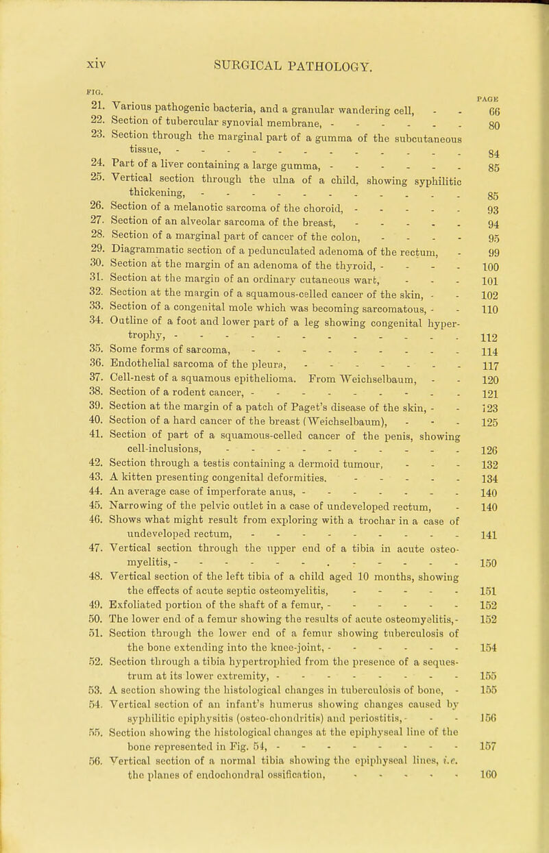 FIQ. 91 -XT • PACK ^1. Various pathogenic bacteria, and a granular wandering cell, - - 06 22. Section of tubercular synovial membrane, 80 23. Section through the marginal part of a gumma of the subcutaneous tissue, 24. Part of a liver containing a large gumma, 85 25. Vertical section through the ulna of a child, showing syphilitic thickening, gg 26. Section of a melanotic sarcoma of the choroid, 93 27. Section of an alveolar sarcoma of the breast, 94 28. Section of a marginal part of cancer of the colon, - - - - 9.5 29. Diagrammatic section of a pedunculated adenoma of the rectum, - 99 30. Section at the margin of an adenoma of the thyroid, - - - . 10O 31. Section at the margin of an ordinary cutaneous wart, - - - 101 32. Section at the margin of a squamous-celled cancer of the skin, - - 102 .33. Section of a congenital mole which was becoming sarcomatous, - - 110 34. Outline of a foot and lower part of a leg showing congenital hyper- trophy, 112 35. Some forms of sarcoma, 114 36. Endothelial sarcoma of the pleurn, II7 37. Cell-nest of a squamous epithelioma. From Weichselbaum, - - 120 38. Section of a rodent cancer, . 12I 39. Section at the margin of a patch of Paget's disease of the skin, - - 123 40. Section of a hard cancer of the breast (Weichselbaum), - - - 125 41. Section of part of a squamous-celled cancer of the penis, showing cell-inclusions, X26 42. Section througli a testis containing a dermoid tumoiir, - - - 132 43. A kitten presenting congenital deformities. - - . . . 134 44. An average case of imperforate anus, 140 45. Narrowing of the pelvic outlet in a case of undeveloped rectum, - 140 40. Shows what might result from exploring with a trochar in a case of undeveloped rectum, 141 47. Vertical section through the upper end of a tibia in acute osteo- myelitis, 150 48. Vertical section of the left tibia of a child aged 10 months, showing the effects of acute septic osteomyelitis, 151 49. Exfoliated portion of the abaft of a femur, 152 50. The lower end of a femur showing the results of acute osteomyelitis,- 152 51. Section through the lower end of a femur showing tuberculosis of the bone extending into the knee-joint, 154 .52. Section through a tibia hj'pertrophied from the presence of a seques- trum at its lower extremity, 155 53. A section showing the histological changes in tuberculosis of bone, - 155 54. Vertical section of an infant's humerus showing changes caused by syphilitic epiphysitis (osteo-chondritis) and periostitis,- - - 166 55. Section showing the histological changes at the epiphyseal line of the bone represented in Fig. 54, 157 56. Vertical section of a normal tibia showing the epiphyseal lines, i.e. the planes of endochondral ossification, 160