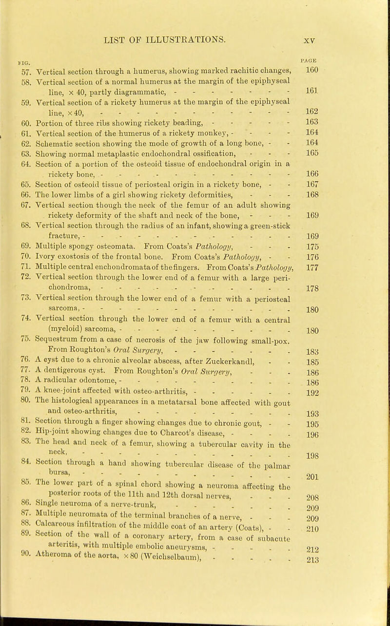 HG. ^AOE 57. Vertical section through a humerus, showing marked rachitic changes, 160 58. Vertical section of a normal humerus at the margin of the epiphyseal line, X 40, partly diagrammatic, - - 161 59. Vertical section of a rickety humerus at the margin of the epiphyseal line, x40, 162 60. Portion of three ribs showing rickety beading, 163 61. Vertical section of the humerus of a rickety monkey, - - - - 164 62. Schematic section showing the mode of growth of a long bone, - - 164 63. Showing normal metaplastic endochondral ossification, - - - 165 64. Section of a portion of the osteoid tissue of endochondral origin in a rickety bone, ----------- 166 65. Section of osteoid tissue of periosteal origin in a rickety bone, - - 167 60. The lower limbs of a girl showing rickety deformities, - - - 168 67. Vertical section though the neck of the femur of an adult showing rickety deformity of the shaft and neck of the bone, - - - 169 68. Vertical section through the radius of an infant, showing a green-stick fracture, 169 69. Multiple spongy osteomata. From Coats's Pathology, - - - 175 70. Ivory exostosis of the frontal bone. From Coats's Pathology, - - 176 71. Multiple central enchondromataofthefingers. From Coats's Pa«/ioZo(/(/, 177 72. Vertical section through the lower end of a femur with a large peri- chondroma, - - - - . - 178 73. Vertical section through the lower end of a femur with a periosteal sarcoma, ---- jgQ 74. Vertical section through the lower end of a femur with a central (myeloid) sarcoma, jgO 75. Sequestrum from a case of necrosis of the jaw following small-pox. From Roughton's Oral Surgery, 18 •{ 76. A cyst due to a chronic alveolar abscess, after Zuckerkandl, - - 185 77. A dentigerous cyst. From Roughton's Oral Surgery, - - - 186 78. A radicular odontorae, Igg 79. A knee-joint affected with osteo-arthritis, 192 80. The histological appearances in a metatarsal bone affected with gout and osteo-arthritis, -j^gg 81. Section through a finger showing changes due to chronic gout, - - 195 82. Hip joint showing changes due to Charcot's disease, - - - - 196 83. The head and neck of a femur, showing a tubercular cavity in the neck193 84. Section through a hand showing tubercular disease of the palmar '''•sa, 201 85. The lower part of a spinal chord showing a neuroma affecting the posterior roots of the nth and 12th dorsal nerves, - - - 208 86. Single neuroma of a nerve-trunk, 209 87. Multiple neuromata of the terminal branches of a nerve, - - - 209 88. Calcareous infiltration of the middle coat of an artery (Coats) - - oj^q 89. Section of the wall of a coronary artery, from a case of subacute arteritis, with multiple embolic aneurysms, - - . . 212 90. Atheroma of the aorta, x 80 (Weichselbaum), .... 213