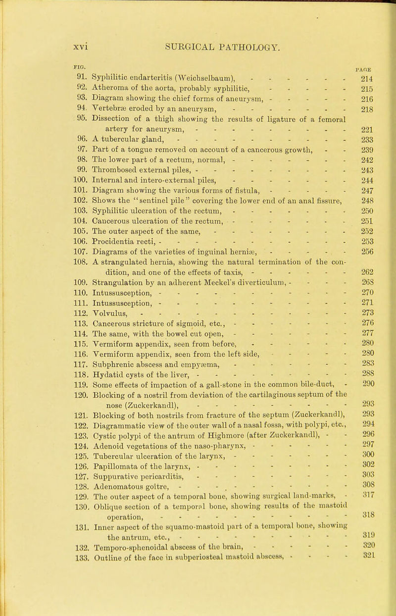 PAOE 91. Syphilitic endarteritis (Weichselbaum), 214 02. Atheroma of the aorta, probabl}' syphilitic, 215 93. Diagram showing the chief forms of aneurysm, 216 94. Vertebrae eroded by an aneurysm, 218 95. Dissection of a thigh showing the results of ligature of a femoral artery for aneurysm, 221 96. A tubercular gland, 233 97. Part of a tongue removed on account of a cancerous growth, - - 239 98. The lower part of a rectum, normal, ------- 242 99. Thrombosed external piles, . - 243 100. Internal and intero-external piles, - - 244 101. Diagram showing the various forms of fistula, 247 102. Shows the sentinel pile covering the lower end of an anal fissure, 248 103. Syphilitic ulceration of the rectum, 250 104. Cancerous ulceration of the rectum, 251 105. The outer aspect of the same, 252 106. Procidentia recti, - . . . 253 107. Diagrams of the varieties of inguinal herniae, 256 108. A strangulated hernia, showing the natural termination of the con- dition, and one of the effects of taxis, - 262 109. Strangulation by an adherent Meckel's diverticulum,. - - - 26S 110. Intussusception, 270 111. Intussusception, 271 112. Volvulus, 273 113. Cancerous stricture of sigmoid, etc., 276 114. The same, with the bowel cut open, ------- 277 115. Vermiform appendix, seen from before, 280 116. Vermiform appendix, seen from the left side, 280 117. Subphrenic abscess and empysema, 283 118. Hydatid cysts of the liver, 288 119. Some effects of impaction of a gall-stone in the common bile-duct, - 290 120. Blocking of a nostril from deviation of the cartilaginous septum of the nose (Zuckerkandl), . - - 293 121. Blocking of both nostrils from fracture of the septum (Zuckerkandl), 293 122. Diagrammatic view of the outer wall of a nasal fossa, with polypi, etc., 294 123. Cystic polypi of the antrum of Highmore (after Zuckerkandl), - - 296 124. Adenoid vegetations of the naso-pharynx, 297 125. Tubercular ulceration of the larynx, 300 126. Papillomata of the larynx, ^02 127. Suppurative pericarditis, 303 128. Adenomatous goitre, - - - , 308 129. The outer aspect of a temporal bone, showing surgical land-marks, - 317 130. Oblique section of a tempoml bone, showing results of the mastoid operation, ^^^ 131. Inner aspect of the squamo-mastoid part of a temporal bone, showing the antrum, etc., 319 132. Temporo-sphenoidal abscess of the brain, 320 133. Outline .of the face in subperiosteal mastoid abscess, ... - 321