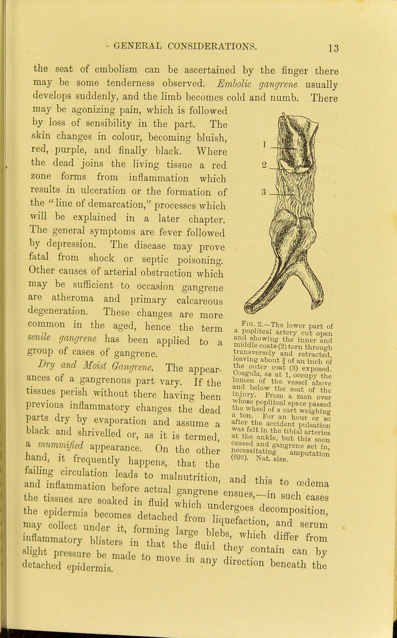 There the seat of embolism can be ascertained by the finger there may be some tenderness observed. Embolic gangrene usually develops suddenly, and the limb becomes cold and numb, may be agonizing pain, which is followed by loss of sensibility in the part. The skin changes in colour, becoming bluish, red, purple, and finally black. Where the dead joins the living tissue a red zone forms from inflammation which results in ulceration or the formation of the line of demarcation, processes which will be explained in a later chapter. The general symptoms are fever followed by depression. The disease may prove fatal from shock or septic poisoning. Other causes of arterial obstruction which may be sufficient to occasion gangrene are atheroma and primary calcareous degeneration. These changes are more common in the aged, hence the term senile gangrene has been applied to a group of cases of gangrene. Dry and Moist Gangrene. The appear- ances of a gangrenous part vary. If the tissues perish without there having been previous inflammatory changes the dead parts dry by evaporation and assume a black and shrivelled or, as it is termed a mummified appearance. On the other hand, It frequently happens, that the failing circulation leads to malnutrition, and thi. fn a and inflammation before actual gangrene ensues ^ T the tissues are soaked in fluid which undir 7 the epidermis becomes detached f^^ot may collect unrlpr if f^. • i queiaction, and serum slight nrcsanrp ™. i . ' ^ ran by Fig 2.—The lower part of a popliteal artery cut open '^.^ showing the inner and middle coats (2) torn through transversely and retracted, leaving about f of an inch of the outer coat (3) exposed. Coagula, as at 1, occupy the luroeu of the vessel above and below the seat of the injury. From a man over whose popliteal space passed the wheel of a cart weighing '^'^ l^our 1- so after the accident pulsation was felt m the tibial arteries at the ankle, but this soon ceased and gangrene set in, amputation \S>'ai). iS.at. size.