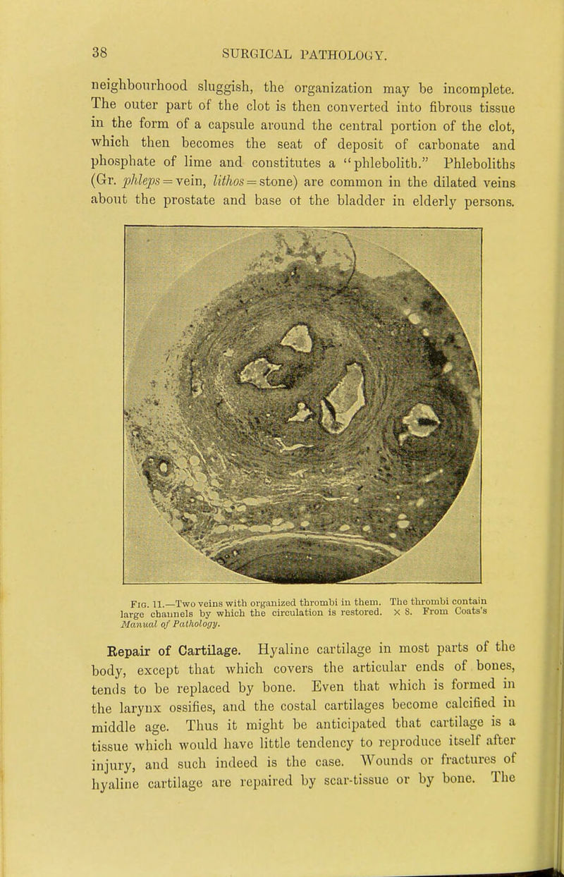 neighbourhood sluggish, the organization may be incomplete. The outer part of the clot is then converted into fibrous tissue in the form of a capsule around the central portion of the clot, which then becomes the seat of deposit of carbonate and phosphate of lime and constitutes a  phlebolitb. Phleboliths (Gr. ^Meps = vein, lithos = stone) are common in the dilated veins about the prostate and base ot the bladder in elderly persons. Fig. 11. Two veins with organized thrombi iu them. The thrombi contain large channels by which the circulation is restored, x S. From Coats's Manv.0.1 of Pathology. Eepair of Cartilage. Hyaline cartilage in most parts of the body, except that which covers the articular ends of bones, tends to be replaced by bone. Even that which is formed in the larynx ossifies, and the costal cartilages become calcified in middle age. Thus it might be anticipated that cartilage is a tissue which would have little tendency to reproduce itself after injury, and such indeed is the case. Wounds or fractures of hyaline cartilage are repaired by scar-tissue or by bone. The