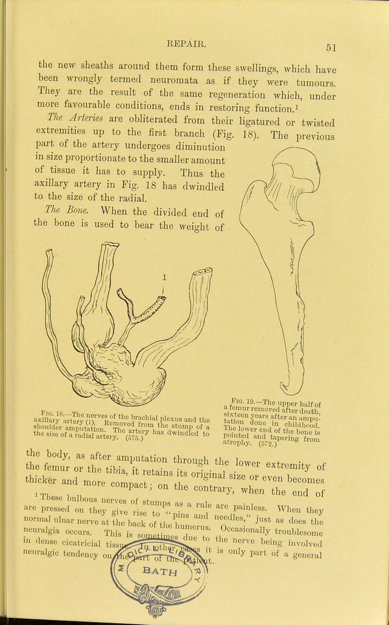 51 the new sheaths around them form these swellings, which have been wrongly termed neuromata as if they were tumours. TJiey are the result of the same regeneration which, under more favourable conditions, ends in restoring function.i The Arteries are obliterated from their ligatured or twisted extremities up to the first branch (Fig. 18). The previous part of the artery undergoes diminution in size proportionate to the smaller amount of tissue it has to supply. Thus the axillary artery in Fig. 18 has dwindled to the size of the radial. The Bone. When the divided end of the bone is used to bear the weight of shoulder .amputation Thn . 'ump of a Pig. 19.-The upper half of a femur removed after death sixteen years after au amp : done in childho^ . Xlie lower end of tlie bone is the body, as after amputation throu-h thf> low.. . • the femur or the tibJ. ,> ,.of • ^^^^ '^^^1 extremity of iiennilgia occir,. This is «,,„«, , 0«<«»oniilIy trouMesome in .iMse oiotricial tissji-S^gfSs^ «= involved neuralgic te„<lc,„j, m/fiS&Jtrk-ai^^ °' * S'!