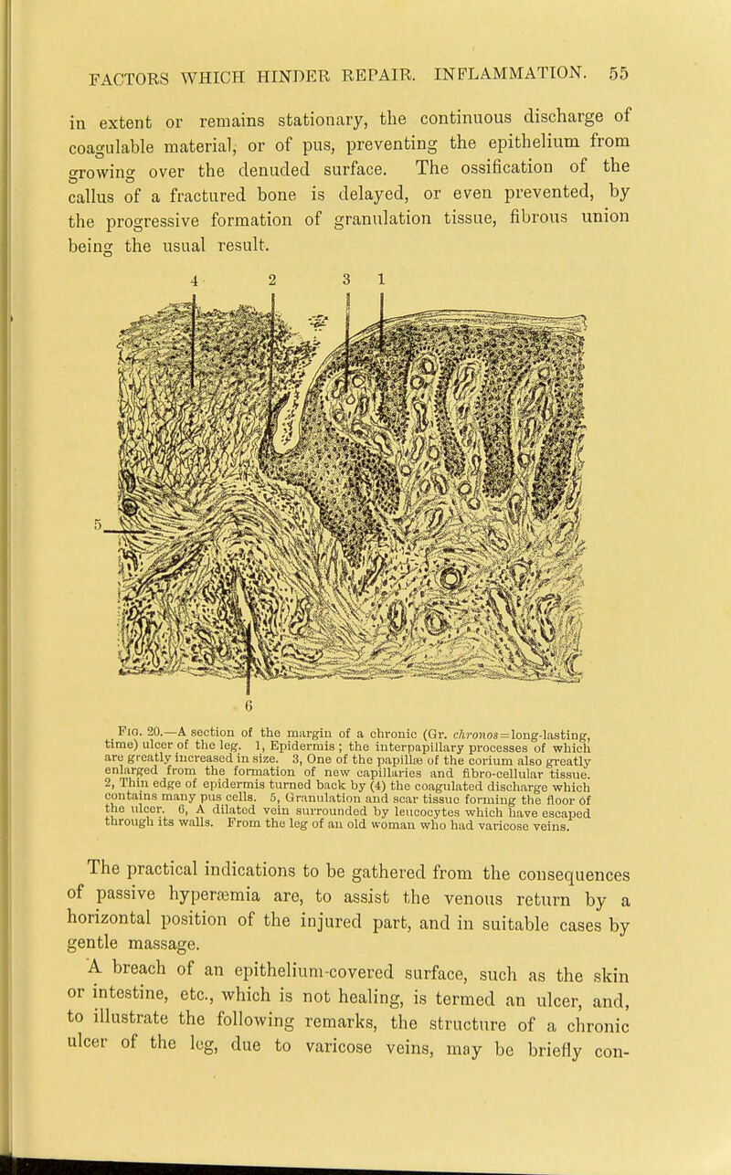 in extent or remains stationary, the continuous discharge of coagulable material, or of pus, preventing the epithelium from growing over the denuded surface. The ossification of the callus of a fractured bone is delayed, or even prevented, by the progressive formation of granulation tissue, fibrous union being the usual result. 4 2 3 1 6 Pio. 20.—A section of the margin of a chronic (Gr. cA)-o)jos = long-lasting, time) ulcer of the leg. 1, Epidermis ; the interpapillary processes of which are greatly increased in size. 3, One of the papillse of the corium also greatly enlarged from the formation of new capillaries and fibro-cellular tissue. 2, Thin edge of epidermis turned back by (4) the coagulated discharge which contains many pus cells. 5, Granulation and scar tissue forming the floor of the ulcer. 0, A dilated vein surrounded by leucocytes which have escaped through its walls. From the leg of an old woman who had varicose veins The practical indications to be gathered from the consequences of passive hyperajmia are, to assist the venous return by a horizontal position of the injured part, and in suitable cases by gentle massage. A breach of an epithelium-covered surface, such as the skin or intestine, etc., which is not healing, is termed an ulcer, and, to illustrate the following remarks, the structure of a chronic ulcer of the log, due to varicose veins, may be briefly con-