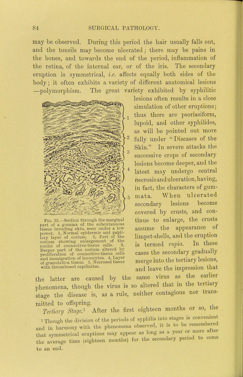 may be observed. During this period the hair usually falls out, and the tonsils may become ulcerated; there may be pains in the bones, and towards the end of the period, inflammation of the retina, of the internal ear, or of the iris. The secondary eruption is symmetrical, i.e. affects equally both sides of the body; it often exhibits a variety of different anatomical lesions —polymorphism. The great variety exhibited by syphilitic lesions often results in a close *^ simulation of other eruptions; thus there are psoriasiform, lupoid, and other syphilides, as will be pointed out more fully under  Diseases of the Skin. In severe attacks the successive crops of secondary lesions become deeper, and the latest may undergo central necrosis andulceration, having, in fact, the characters of gum- mata. When ulcerated secondary lesions become covered by crusts, and con- tinue to enlarge, the crusts assume the appearance of limpet-shells, and the eruption is termed rupia. In these cases the secondary gradually merge into the tertiary lesions, and leave the impression that the latter are caused by the same virus as the earlier phenomena, though the virus is so altered that in the tertiary stage the disease is, as a rule, neither contagious nor trans- mitted to offspring. Tertiary Stage.^ After the first eighteen months or so, the 1 Though the division of the periods of syphilis into stages is convenient and in harmony with the phenomena observed, it is to be remembered that symmetrical eruptions may appear as long as a year or more after the average time (eighteen months) for the secondary period to come to an end. Fig. 23.—Section through the marginal part of a gumma of the subcutaneous tissue invading skin, seen under a low power. 1, Normal epidermis and papil- lary layer of corium. 2, Part of the corium showing enlargement of the nuclei of connective-tissue cells. 3, Deeper part of the corium altered by proliferation of connective-tissue cells and immigration of leucocytes. 4, Layer of granvilation tissue. 5, Necrosed tissue with thrombosed capillaries.