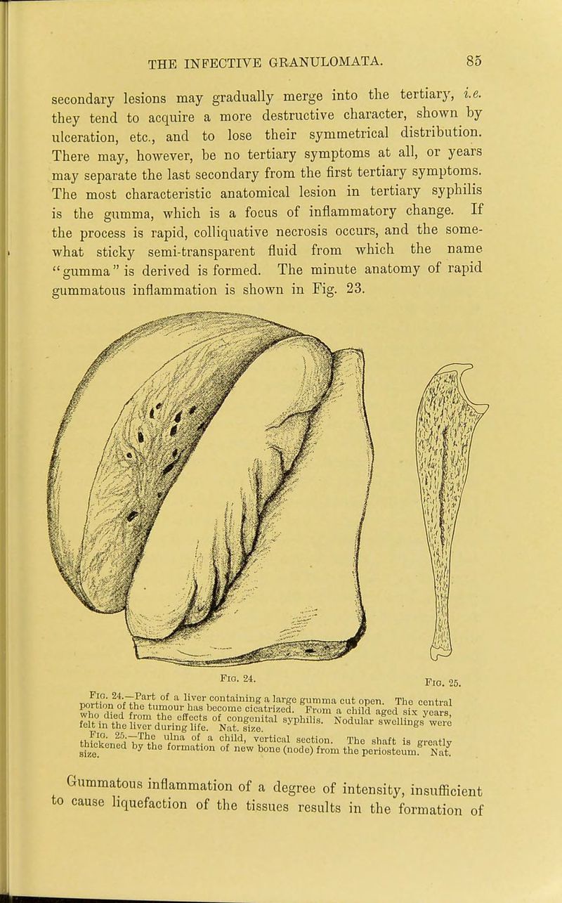 secondary lesions may gradually merge into the tertiary, i.e. they tend to acquire a more destructive character, shown by ulceration, etc., and to lose their symmetrical distribution. There may, however, be no tertiary symptoms at all, or years may separate the last secondary from the first tertiary symptoms. The most characteristic anatomical lesion in tertiary syphilis is the gumma, which is a focus of inflammatory change. If the process is rapid, colliquative necrosis occurs, and the some- what sticky semi-transparent fluid from which the name  gumma  is derived is formed. The minute anatomy of rapid gummatous inflammation is shown in Fig. 23. tm Fio. 24. Fio. 25. mc^'cnJii'^^^l °l ''l^*^' ^'''=''1 «'^<=on. The shaft is greatly thickened by the formation of new bone (node) from the periosteum Nat Gummatous inflammation of a degree of intensity, insufficient to cause hquefaction of the tissues results in the formation of