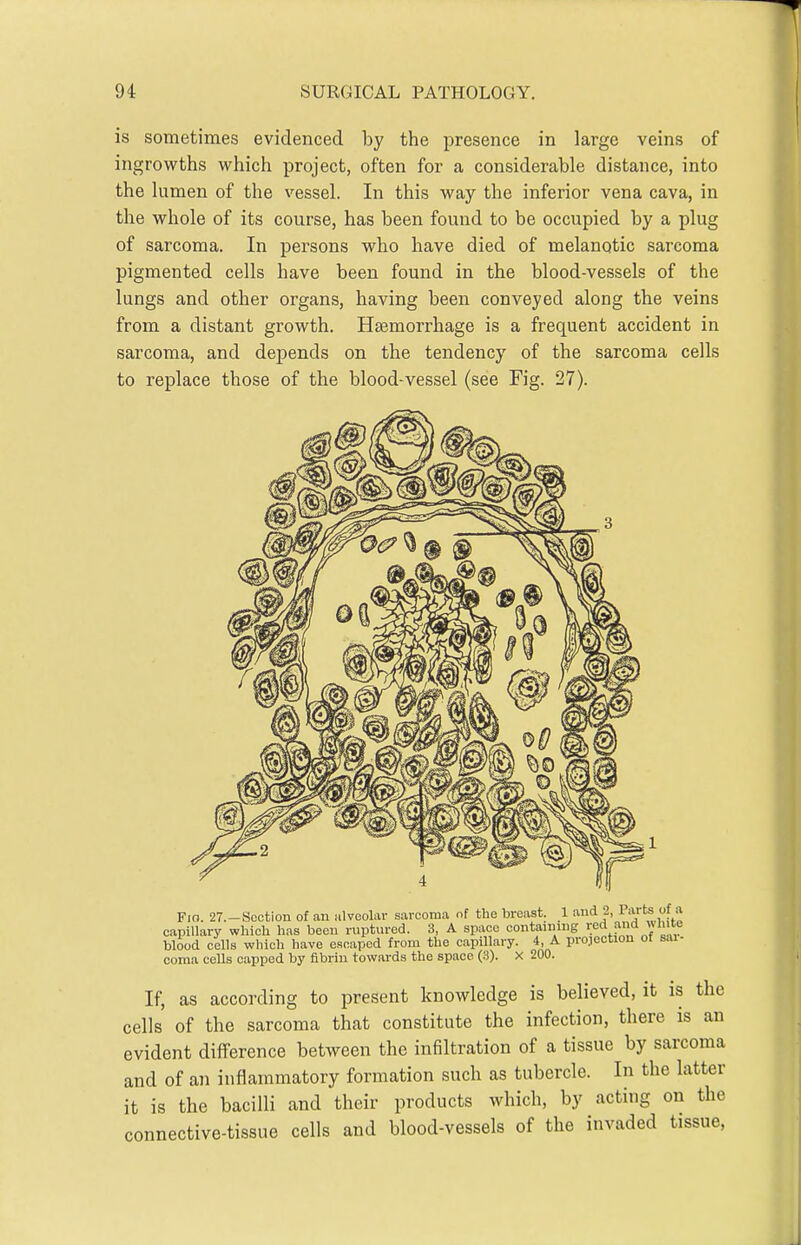 is sometimes evidenced by the presence in large veins of ingrowths which project, often for a considerable distance, into the lumen of the vessel. In this way the inferior vena cava, in the whole of its course, has been found to be occupied by a plug of sarcoma. In persons who have died of melanotic sarcoma pigmented cells have been found in the blood-vessels of the lungs and other organs, having been conveyed along the veins from a distant growth. Haemorrhage is a frequent accident in sarcoma, and depends on the tendency of the sarcoma cells to replace those of the blood-vessel (see Fig. 27). Fio. 27.—Section of an alveolar sarcoma of the breast. 1 and 2, Taits of .v capillary which has been ruptured. 3, A space contaimug re'^ f l'>'f blood cells which have escaped from the capillary. 4, A projection of sai- coma cells capped by fibrin towards the space (3). x 200. If, as according to present knowledge is believed, it is the cells of the sarcoma that constitute the infection, there is an evident difference between the infiltration of a tissue by sarcoma and of an inflammatory formation such as tubercle. In the latter it is the bacilli and their products which, by acting on the connective-tissue cells and blood-vessels of the invaded tissue.
