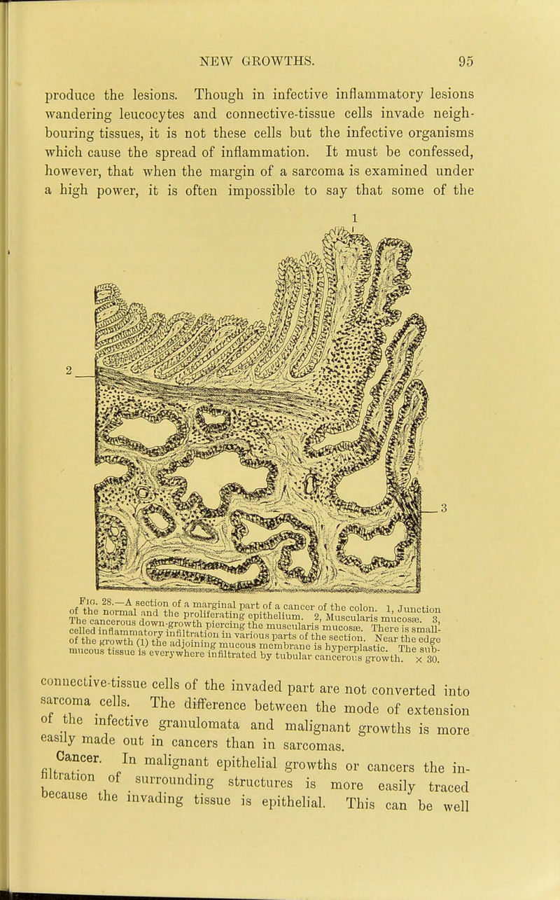 produce the lesions. Though in infective inflammatory lesions wandering leucocytes and connective-tissue cells invade neigh- bouring tissues, it is not these cells but the infective organisms which cause the spread of inflammation. It must be confessed, however, that when the margin of a sarcoma is examined under a high power, it is often impossible to say that some of the J.ltHTn(f down.growth piercing the muscnlaris'mucosi Th^i fmaU- o he KroXaUhe'J '^ '''' Near e^go rn„„l,, +° i'djoinnig mucous membrane is hypernlastic Thp miVi mucous tissue is everywhere infiltrated by tubular can?em^s growth >< 30: connective-tissue cells of the invaded part are not converted into sarcoma cells. The difference between the mode of extension ot the infective granulomata and malignant growths is more easily made out in cancers than in sarcomas. Cancer. In malignant epithelial growths or cancers the in- filtration of surrounding structures is more easily traced t)ecause the invading tissue is epithelial. This can be well
