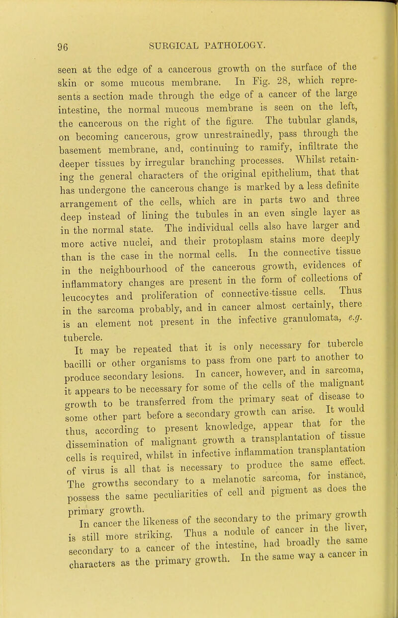 seen at the edge of a cancerous growth on the surface of the skin or some mucous membrane. In Fig. 28, which repre- sents a section made through the edge of a cancer of the large intestine, the normal mucous membrane is seen on the left, the cancerous on the right of the figure. The tubular glands, on becoming cancerous, grow unrestrainedly, pass through the basement membrane, and, continuing to ramify, infiltrate the deeper tissues by irregular branching processes. Whilst retain- ing the general characters of the original epithelium, that that has undergone the cancerous change is marked by a less definite arrangement of the cells, which are in parts two and three deep instead of lining the tubules in an even single layer as in the normal state. The individual cells also have larger and more active nuclei, and their protoplasm stains more deeply than is the case in the normal cells. In the connective tissue in the neighbourhood of the cancerous growth, evidences of inflammatory changes are present in the form of collections of leucocytes and proliferation of connective-tissue cells. ihus in the sarcoma probably, and in cancer almost certainly, there is an element not present in the infective granulomata, e.g. It may be repeated that it is only necessary for tubercle bacilli or other organisms to pass from one part to another to produce secondary lesions. In cancer, however, and in sarcoma it appears to be necessary for some of the cells of the mahgnant .rowth to be transferred from the primary seat of disease o some other part before a secondary growth can arise. It would thus, according to present knowledge, appear ha for diss mination of malignant growth a transplantation o tis ue cells is required, whilst in infective -fl--^^-^;/^-^^^ ^ of virus is all that is necessary to produce the -^^^ The growths secondary to a melanotic sarcoma, foi ^^ancC' possess the same peculiarities of cell and pigment as does the ^t^r;tlikeness of the secondary to the »ro^ is still more striking. Thus a nodule of cancer m ^le h er secondary to a cancer of the intestine, had broadly the same secoiiuciij' cancer m characters as the primary growth. In the same way