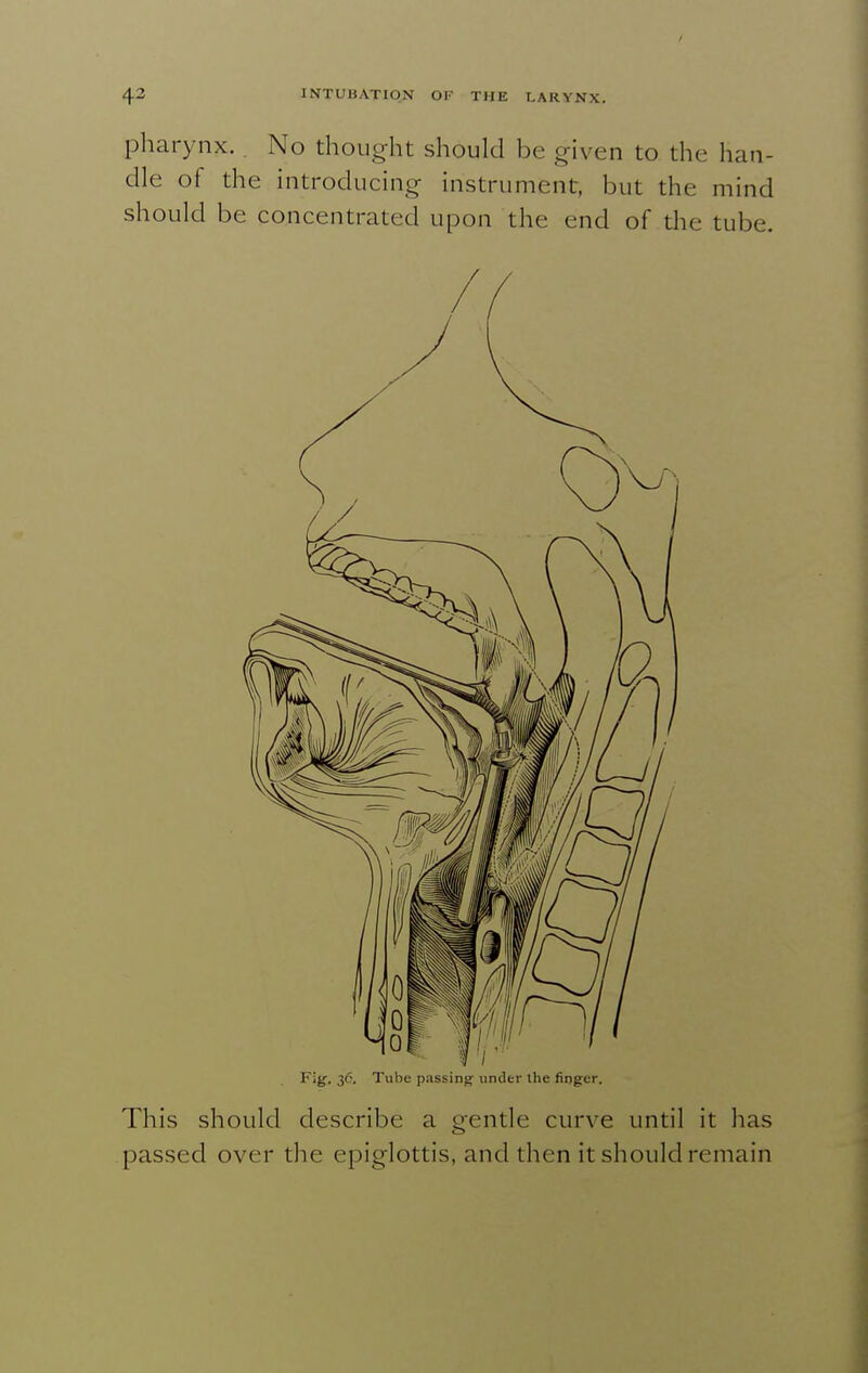 pharynx.. No thought should be given to the han- dle of the introducing instrument, but the mind should be concentrated upon the end of the tube. Fig. 36. Tube passing unilei- llie finger. This should describe a gentle curve until it has passed over the epiglottis, and then it should remain