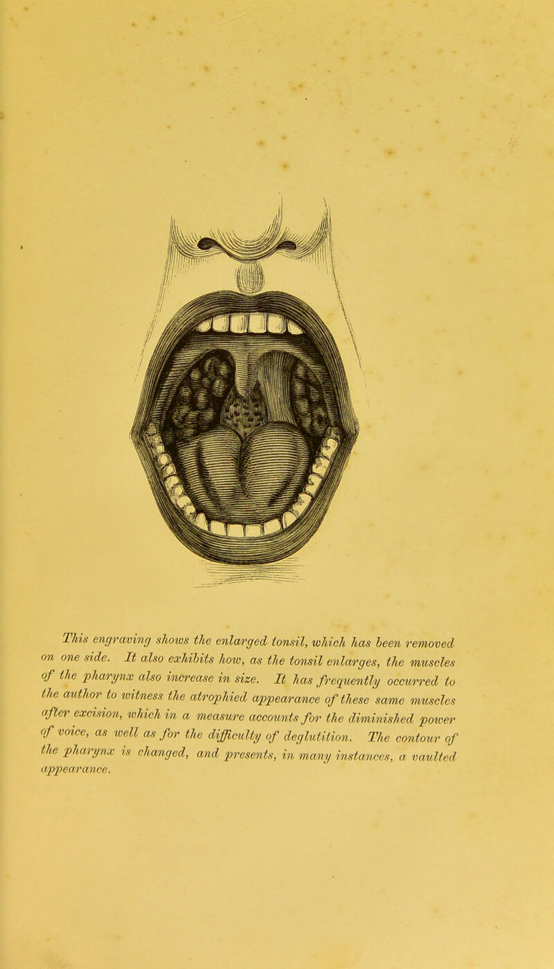 This engraving shows the enlarged tonsil, which has been removed on one side. It also exhibits how, as the tonsil enlarges, the muscles of the pharynx also increase in size. It has frequently occurred to the author to witness the atrophied appearance of these same muscles after excision, which in a measure accounts for the diminished power of voice, as well as for the difficulty of deglutition. The contour of the pharynx is changed, and presents, in many instances, a vaulted appearance.