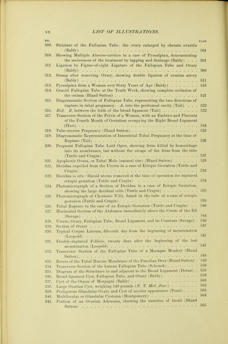 W6. PAGE 309. Stricture of the Fallopian Tube: the ovary enlarged by chronic ovaritis (Baldy) 501 310. Showing Multiple Abscess-cavities in a case of Pyosalpinx, demonstrating the uselessness of the treatment by tapping and drainage (Baldy) . . . 501 311. Ligation by Figure-of-eight Ligature of the Fallopian Tube and Ovary (Baldy) 508 312. Stump after removing Ovary, showing double ligation of ovarian artery (Baldy) 511 313. Pyosalpinx from a Woman over Sixty Years of Age (Baldy) 515 314. Gravid Fallopian Tube at the Tenth Week, showing complete occlusion of the ostium (Bland Sutton) 521 315. Diagrammatic Section of Fallopian Tube, representing the two directions of rupture in tubal pregnancy. A, into the peritoneal cavity (Tait) . . . 522 316. Ibid. B, between the folds of the broad ligament (Tait) 522 317. Transverse Section of the Pelvis of a Woman, with an Embryo and Placenta of the Fourth Month of Gestation occupying the Right Broad Ligament (Hart) 524 318. Tubo-uterine Pregnancy (Bland Sutton) 525 319. Diagrammatic Representation of Interstitial Tubal Pregnancy at the time of Rupture (Tait) 526 320. Pregnant Fallopian Tube Laid Open, showing fetus killed by hemorrhage into its membranes, but without the escape of the fetus from the tube (Tuttle and Cragin) 527 321. Apoplectic Ovum, or Tubal Mole (natural size) (Bland Sutton) 528 322. Decidua expelled from the Uterus in a case of Ectopic Gestation (Tuttle and Cragin) 533 323. Decidua in silu : fibroid uterus removed at the time of operation for ruptured ectopic gestation (Tuttle and Cragin) 534 324. Photomicrograph of a Section of Decidua in a case of Ectopic Gestation, showing the large decidual cells (Tuttle and Cragin) 535 325. Photomicrograph of Chorionic Villi, found in the tube of a case of ectopic gestation (Tuttle and Cragin) 538 326. Tubal Rupture in the case of an Ectopic Gestation (Tuttle and Cragin) . . 540 327. Horizontal Section of the Abdomen immediately above the Crests of the Ilii (Savage) 544 328. Uterus, Ovary, Fallopian Tube, Broad Ligament, and its Contents (Savage) . 546 329. Section of Ovary 547 330. Typical Corpus Luteum, fifteenth day from the beginning of menstruation (Leopold) 547 331. Freshly-ruptured Follicle, twenty days after the beginning of the last menstruation (Leopold) 547 332. Transverse Section of the Fallopian Tube of a Macaque Monkey (Bland Sutton) 548 333. Recess of the Tubal Mucous Membrane of the Panolian Deer (Bland Sutton) . 549 3:54. Transverse Section of the human Fallopian Tube (Schenck) 550 335. Diagram of the Structures in and adjacent to the Broad Ligament (Doran) . 558 336. Broad-ligament Cyst, Fallopian Tube, and Ovary (Baldy) 559 337. Cyst of the Organ of Morgagni (Baldy) 560 338. Large Ovarian Cyst, weighing 149 pounds {N. Y. Med. Jour.) 562 339. Proligerous Glandular Ovary and Cyst of areolar appearance (Pozzi) . . . . 563 340. Multilocular or Glandular Cystoma (Montgomery) 564 341. Portion of an Ovarian Adenoma, showing the varieties of loculi (Bland Sutton) 565