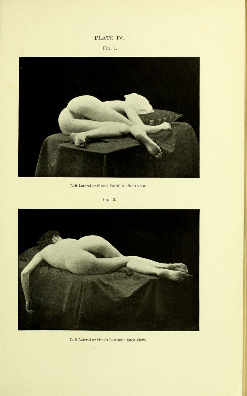 PLATE IV. Fig. 1. Left Lateral or Sims's Position: front view. Fig. 2. Left Lateral or Sims's Position: back view.