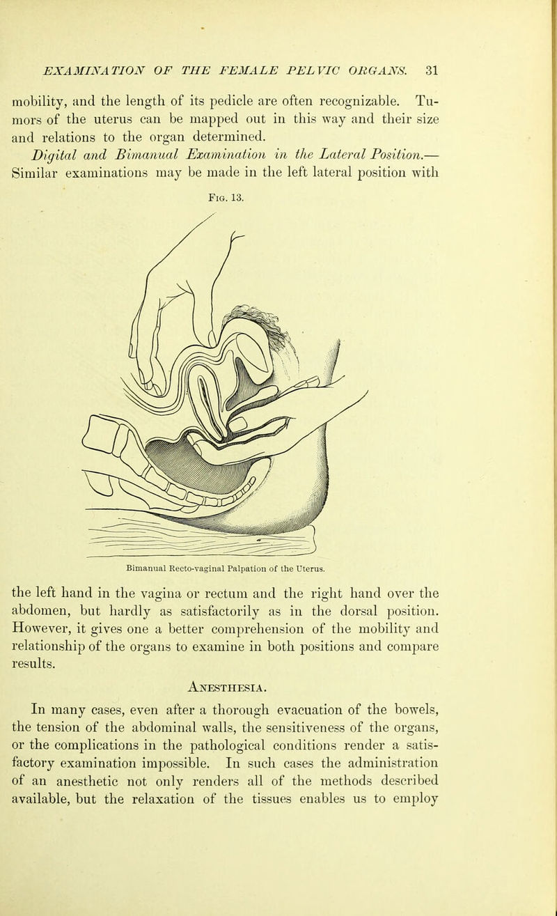 mobility, and the length of its pedicle are often recognizable. Tu- mors of the uterus can be mapped out in this way and their size and relations to the organ determined. Digital and Bimanual Examination in the Lateral Position.— Similar examinations may be made in the left lateral position with Fig. 13. Bimanual Recto-vaginal Palpation of the Uterus. the left hand in the vagina or rectum and the right hand over the abdomen, but hardly as satisfactorily as in the dorsal position. However, it gives one a better comprehension of the mobility and relationship of the organs to examine in both positions and compare results. Anesthesia. In many cases, even after a thorough evacuation of the bowels, the tension of the abdominal walls, the sensitiveness of the organs, or the complications in the pathological conditions render a satis- factory examination impossible. In such cases the administration of an anesthetic not only renders all of the methods described available, but the relaxation of the tissues enables us to employ