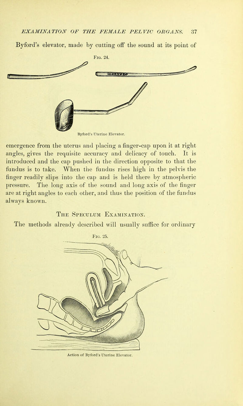 By ford's elevator, made by cutting off the sound at its point of Fig. 24. Byford's Uterine Elevator. emergence from the uterus and placing a finger-cap upon it at right angles, gives the requisite accuracy and delicacy of touch. It is introduced and the cap pushed in the direction opposite to that the fundus is to take. When the fundus rises high in the pelvis the finger readily slips into the cap and is held there by atmospheric pressure. The long axis of the sound and long axis of the finger are at right angles to each other, and thus the position of the fundus always known. The Speculum Examination. The methods already described will usually suffice for ordinary Fig. 25. Action of Byford's Uterine Elevator.