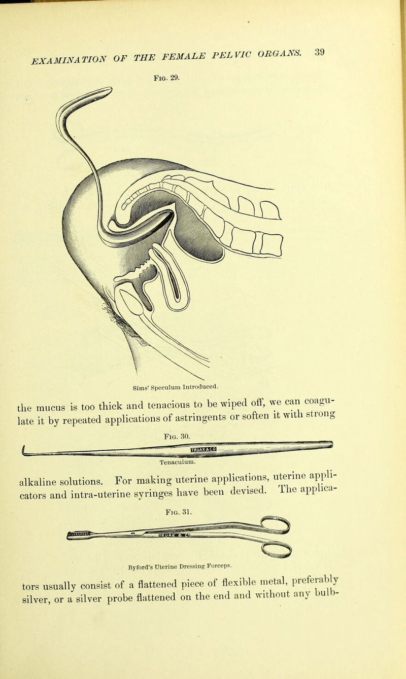 Fig. 29. Sims' Speculum Introduced. the mucus is too thick and tenacious to be wiped off, we can coagu- late it by repeated applications of astringents or soften it with strong Fig. 30. Tenaculum. alkaline solutions. For making uterine applications, uterine appli- cators and intra-uterine syringes have been devised. The applica- Fig. 31. Byford's Uterine Dressing Forceps. tors usually consist of a flattened piece of flexible metal, preferably silver, or a silver probe flattened on the end and without any bulb-