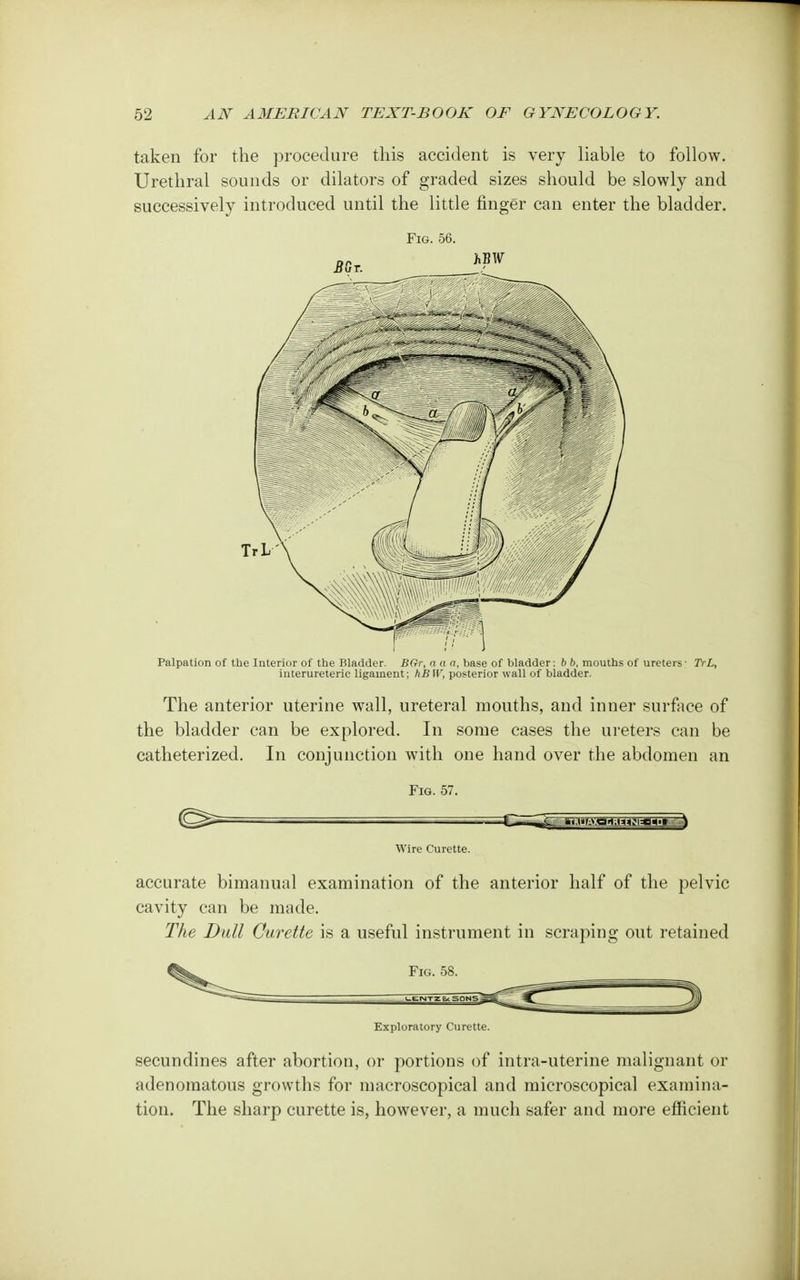 taken for the procedure this accident is very liable to follow. Urethral sounds or dilators of graded sizes should be slowly and successively introduced until the little finger can enter the bladder. Fig. 56. BGr. TrL Palpation of the Interior of the Bladder. BGr, a a a, base of bladder: b ft, mouths of ureters • TrL, interureteric ligament; hBW, posterior wall of bladder. The anterior uterine wall, ureteral mouths, and inner surface of the bladder can be explored. In some cases the ureters can be catheterized. In conjunction with one hand over the abdomen an Fig. 57. =C—3-^ *i|-'i3g;L>^*?l*j*'.g } Wire Curette. accurate bimanual examination of the anterior half of the pelvic cavity can be made. The Dull Curette is a useful instrument in scraping out retained Fig. 58. -LENTZ8. 5QN5 ^ Exploratory Curette. secundines after abortion, or portions of intra-uterine malignant or adenomatous growths for macroscopical and microscopical examina- tion. The sharp curette is, however, a much safer and more efficient