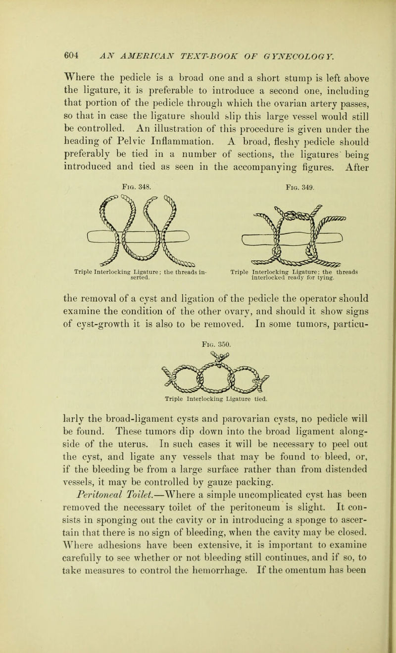 Where the pedicle is a broad one and a short stump is left above the ligature, it is preferable to introduce a second one, including that portion of the pedicle through which the ovarian artery passes, so that in case the ligature should slip this large vessel would still be controlled. An illustration of this procedure is given under the heading of Pelvic Inflammation. A broad, fleshy pedicle should preferably be tied in a number of sections, the ligatures being introduced and tied as seen in the accompanying figures. After Fig. 348. Fig. 349. Triple Interlocking Ligature; the threads in- Triple Interlocking Ligature; the threads serted. interlocked ready for tying. the removal of a cyst and ligation of the pedicle the operator should examine the condition of the other ovary, and should it show signs of cyst-growth it is also to be removed. In some tumors, particu- Fig. 350. Triple Interlocking Ligature tied. larly the broad-ligament cysts and parovarian cysts, no pedicle will be found. These tumors dip down into the broad ligament along- side of the uterus. In such cases it will be necessary to peel out the cyst, and ligate any vessels that may be found to bleed, or, if the bleeding be from a large surface rather than from distended vessels, it may be controlled by gauze packing. Peritoneal Toilet.—Where a simple uncomplicated cyst has been removed the necessary toilet of the peritoneum is slight. It con- sists in sponging out the cavity or in introducing a sponge to ascer- tain that there is no sign of bleeding, when the cavity may be closed. Where adhesions have been extensive, it is important to examine carefully to see whether or not bleeding still continues, and if so, to take measures to control the hemorrhage. If the omentum has been