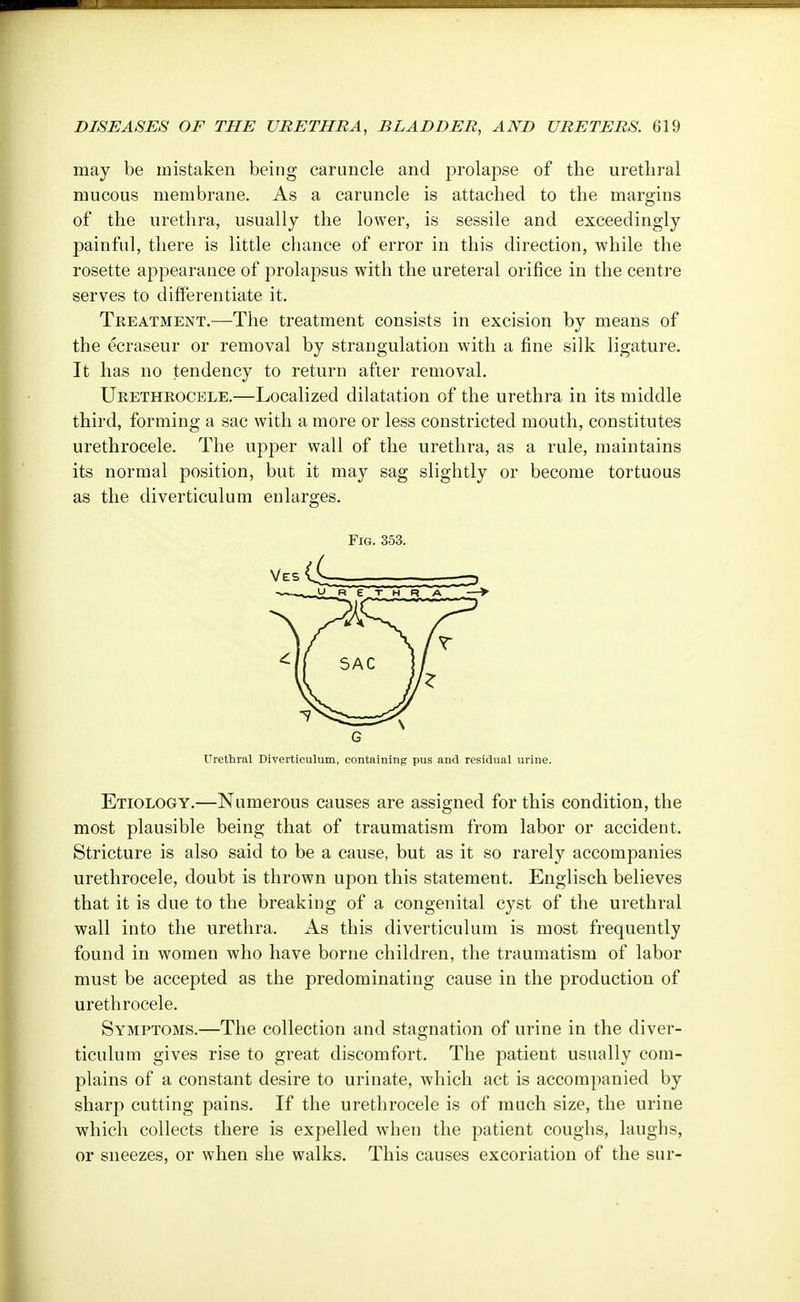 may be mistaken being caruncle and prolapse of the urethral mucous membrane. As a caruncle is attached to the margins of the urethra, usually the lower, is sessile and exceedingly painful, there is little chance of error in this direction, while the rosette appearance of prolapsus with the ureteral orifice in the centre serves to differentiate it. Treatment.—The treatment consists in excision by means of the ecraseur or removal by strangulation with a fine silk ligature. It has no tendency to return after removal. Urethrocele.—Localized dilatation of the urethra in its middle third, forming a sac with a more or less constricted mouth, constitutes urethrocele. The upper wall of the urethra, as a rule, maintains its normal position, but it may sag slightly or become tortuous as the diverticulum enlarges. Fig. 353. G Urethral Diverticulum, containing pus and residual urine. Etiology.—Numerous causes are assigned for this condition, the most plausible being that of traumatism from labor or accident. Stricture is also said to be a cause, but as it so rarely accompanies urethrocele, doubt is thrown upon this statement. Englisch believes that it is due to the breaking of a congenital cyst of the urethral wall into the urethra. As this diverticulum is most frequently found in women who have borne children, the traumatism of labor must be accepted as the predominating cause in the production of urethrocele. Symptoms.—The collection and stagnation of urine in the diver- ticulum gives rise to great discomfort. The patient usually com- plains of a constant desire to urinate, which act is accompanied by sharp cutting pains. If the urethrocele is of much size, the urine which collects there is expelled when the patient coughs, laughs, or sneezes, or when she walks. This causes excoriation of the sur-