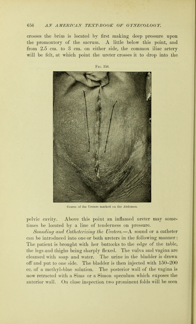 crosses the brim is located by first making deep pressure upon the promontory of the sacrum. A little below this point, and from 2.5 cm. to 3 cm. on either side, the common iliac artery will be felt, at which point the ureter crosses it to drop into the Fig. 356. Course of the Ureters marked on the Abdomen. pelvic cavity. Above this point an inflamed ureter may some- times be located by a line of tenderness on pressure. Sounding and Catheterizing the Ureters.—A sound or a catheter can be introduced into one or both ureters in the following manner: The patient is brought with her buttocks to the edge of the table, the legs and thighs being sharply flexed. The vulva and vagina are cleansed with soap and water. The urine in the bladder is drawn off and put to one side. The bladder is then injected with 150-200 cc. of a methyl-blue solution. The posterior wall of the vagina is now retracted with a Sims or a Simon speculum which exposes the anterior wall. On close inspection two prominent folds will be seen