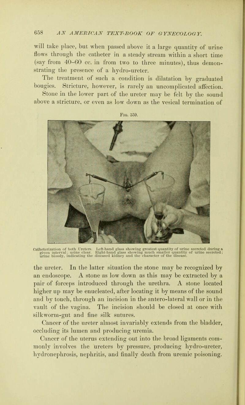 will take place, but when passed above it a large quantity of urine flows through the catheter in a steady stream within a short time (say from 40-60 cc. in from two to three minutes), thus demon- strating the presence of a hydro-ureter. The treatment of such a condition is dilatation by graduated bougies. Stricture, however, is rarely an uncomplicated affection. Stone in the lower part of the ureter may be felt by the sound above a stricture, or even as low down as the vesical termination of Fig. 359. Catheterization of both Ureters. Left-hand glass showing greatest quantity of urine secreted during a given interval; urine clear. Right-hand glass showing much smaller quantity of urine secreted; urine bloody, indicating the diseased kidney and the character of the disease. the ureter. In the latter situation the stone may be recognized by an endoscope. A stone as low down as this may be extracted by a pair of forceps introduced through the urethra. A stone located higher up may be enucleated, after locating it by means of the sound and by touch, through an incision in the antero-lateral wall or in the vault of the vagina. The incision should be closed at once with silkworm-gut and fine silk sutures. Cancer of the ureter almost invariably extends from the bladder, occluding its lumen and producing uremia. Cancer of the uterus extending out into the broad ligaments com- monly involves the ureters by pressure, producing hydro-ureter, hydronephrosis, nephritis, and finally death from uremic poisoning.