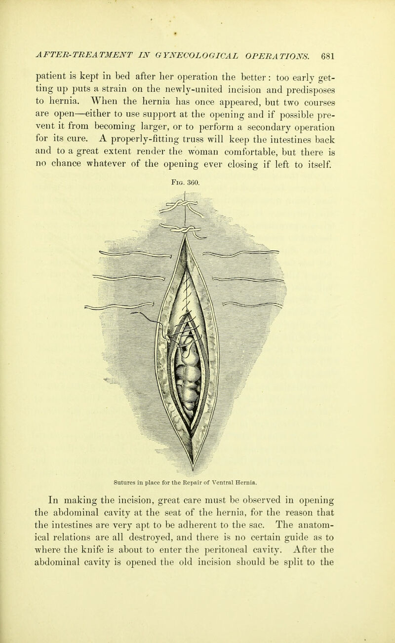 patient is kept in bed after her operation the better: too early get- ting up puts a strain on the newly-united incision and predisposes to hernia. When the hernia has once appeared, but two courses are open—either to use support at the opening and if possible pre- vent it from becoming larger, or to perform a secondary operation for its cure. A properly-fitting truss will keep the intestines back and to a great extent render the woman comfortable, but there is no chance whatever of the opening ever closing if left to itself. Fig. 360. Sutures in place for the Repair of Ventral Hernia. In making the incision, great care must be observed in opening the abdominal cavity at the seat of the hernia, for the reason that the intestines are very apt to be adherent to the sac. The anatom- ical relations are all destroyed, and there is no certain guide as to where the knife is about to enter the peritoneal cavity. After the abdominal cavity is opened the old incision should be split to the
