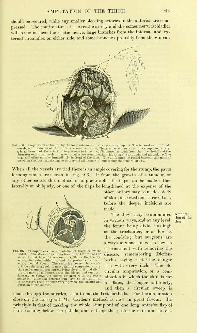 should be secured, while any smaller bleeding arteries in the anterior are com- pressed. The continuation of the sciatic artery and the comes nervi ischiadici will be found near the sciatic nerve, large branches from the internal and ex- ternal circumflex on either side, and some branches probably from the gluteal. Fig. 400. Amputation at the hip by the long anterior and short posterior flap, a, The femoral and profunda vessels, with branches of the anterior crural nerve. B, The great sciatic nerve and its companion artery. A large branch of the sciatic artery is seen in front, c, The muscular mass from the tuber isehii and the obturator extemus muscle. Large branches are seen on either side from the profunda and gluteal. i>, The psoas and other muscles immediately in front of the joint. The knife must be passed beneath this mass of muscle in the first transfixion, so as to avoid all danger of puncturing the femoral artery. When all the vessels are tied there is an ample covering for the stump, the parts forming which are shown in Fig. 40C. If from the growth of a tumour, or any other cause, this method is impracticable, the flaps can be made either laterally or oblicpiely, or one of the flaps be lengthened at the expense of the other, or they may be made chiefly of skin, dissected and turned back before the deeper incisions are made. The thieh may be amputated Amputa- & ,.i i tion of the m various ways, and at any level, thigh. the femur being divided as high as the trochanter, or as low as the condyle; but surgeons are always anxious to go as low as is consistent with removing the disease, remembering Dieffen- bach's saying that ' the danger rises with every inch.' The old circular amputation, or a com- bination in which the skin is cut in flaps, the longer anteriorly, and then a circular sweep is made through the muscles, seem to me the best methods. For the amputation close on the knee-joint Mr. Garden's method is now in great favour. Its principle is that of making the whole stump out of one long anterior flap of skin reaching below the patella, and cutting the posterior skin and muscles Fig. 407. Stump of circular amputation of thigh below the middle. The sleeve of skin has been quite turned back to show the flat face of the stump. A, Shows the femoral artery, its vein behind it, and the profunda vein and artery behind them. The sartorius covers the vessels. B, Shows the great sciatic nerve and its companion artery, the semi-memhranosus muscle lying close to it and divid- ing the mass of adductors from the biceps and semi-ten- dinosus. c, Shows the triceps extensor with the rectus above it. Muscular arteries will have to be tied in all these masses, their number varying with the nature and duration of the disease.