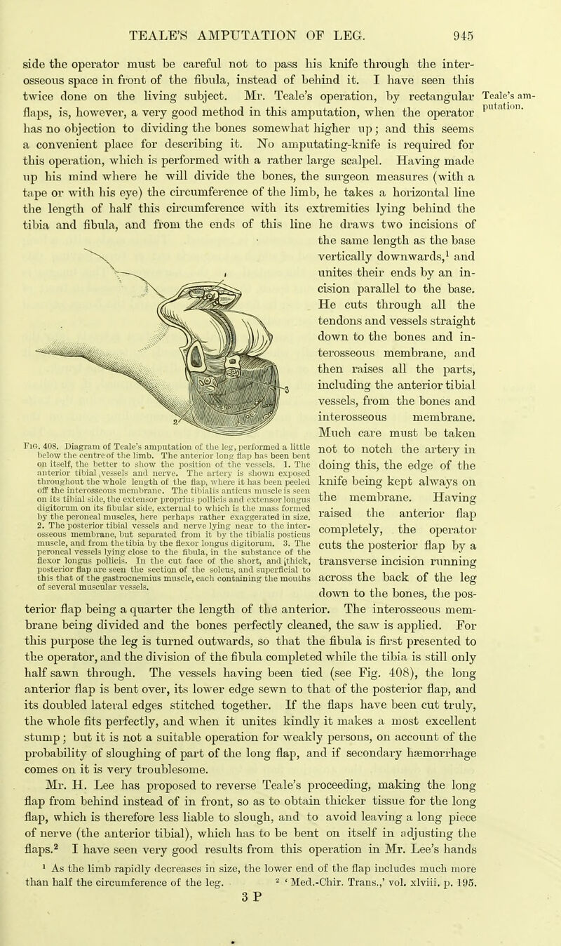 side the operator must be careful not to pass his knife through the inter- osseous space in front of the fibula, instead of behind it. I have seen this twice done on the living subject. Mr. Teale's operation, by rectangular flaps, is, however, a very good method in this amputation, when the operator has no objection to dividing the bones somewhat higher up; and this seems a convenient place for describing it. No amputating-knife is required for this operation, which is performed with a rather large scalpel. Having made up his mind where he will divide the bones, the surgeon measures (with a tape or with his eye) the circumference of the limb, he takes a horizontal line the length of half this circumference with its extremities lying beliind the tibia and fibula, and from the ends of this line he draws two incisions of the same length as the base vertically downwards,1 and unites their ends by an in- cision parallel to the base. He cuts through all the tendons and vessels straight down to the bones and in- terosseous membrane, and then raises all the parts, including the anterior tibial vessels, from the bones and interosseous membrane. Much care must be taken Fig. 408. Diagram of Teale's amputation of the leg, performed a little not to notch the ai'terv in below the centre of the limb. The anterior long flap has been bent _ _ * on itself, the better to show the position of the vessels. 1. The doing this, the edCTe of the anterior tibial vessels and nerve. The artery is shown exposed .. . throughout the whole length of the flap, where it has been peeled knife being kept always Oil off the interosseous membrane. The tibialis anticus muscle is seen , TT on its tibial side, the extensor proprius pollicis and extensor longus the mem brane. Having digitorum on its fibular side, external to which ia the mass formed ,.„,•„„,] +1 0 +o * A by the peroneal muscles, here perhaps rather exaggerated in size. alBou bite anterior nap 2. The posterior tibial vessels and nerve lying near to the inter- pnnrnlo+plv rvrvovn+mi osseous membrane, but separated from it by the tibialis posticus ^lupreteiy, tiie upeiduui muscle, and from the tibia by the flexor longus digitorum. 3. The cuts the posterior flap bv a peroneal vessels lying close to the fibula, in the substance of the ... . flexor longus poinds. In the cut face of the short, and ithick, transverse incision running posterior flap are seen the section of the soleus, and superficial to ■ this that of the gastrocnemius muscle, each containing the mouths acrOSS the back of the leg of several muscular vessels. , , ., -, ,-, down to the bones, the pos- terior flap being a quarter the length of the anterior. The interosseous mem- brane being divided and the bones perfectly cleaned, the saw is applied. For this purpose the leg is turned outwards, so that the fibula is first presented to the operator, and the division of the fibula completed while the tibia is still only half sawn through. The vessels having been tied (see Fig. 408), the long anterior flap is bent over, its lower edge sewn to that of the posterior flap, and its doubled lateral edges stitched together. If the flaps have been cut truly, the whole fits perfectly, and when it unites kindly it makes a most excellent stump; but it is not a suitable operation for weakly persons, on account of the probability of sloughing of part of the long flap, and if secondary haemorrhage comes on it is very troublesome. Mr. H. Lee has proposed to reverse Teale's proceeding, making the long flap from behind instead of in front, so as to obtain thicker tissue for the long flap, which is therefore less liable to slough, and to avoid leaving a long piece of nerve (the anterior tibial), which has to be bent on itself in adjusting the flaps.2 I have seen very good results from this operation in Mr. Lee's hands 1 As the limb rapidly decreases in size, the lower end of the flap includes much more than half the circumference of the leg. 2 'Med.-Chir. Trans.,' vol. xlviii. p. 195. 3 P Teale's am- putation.
