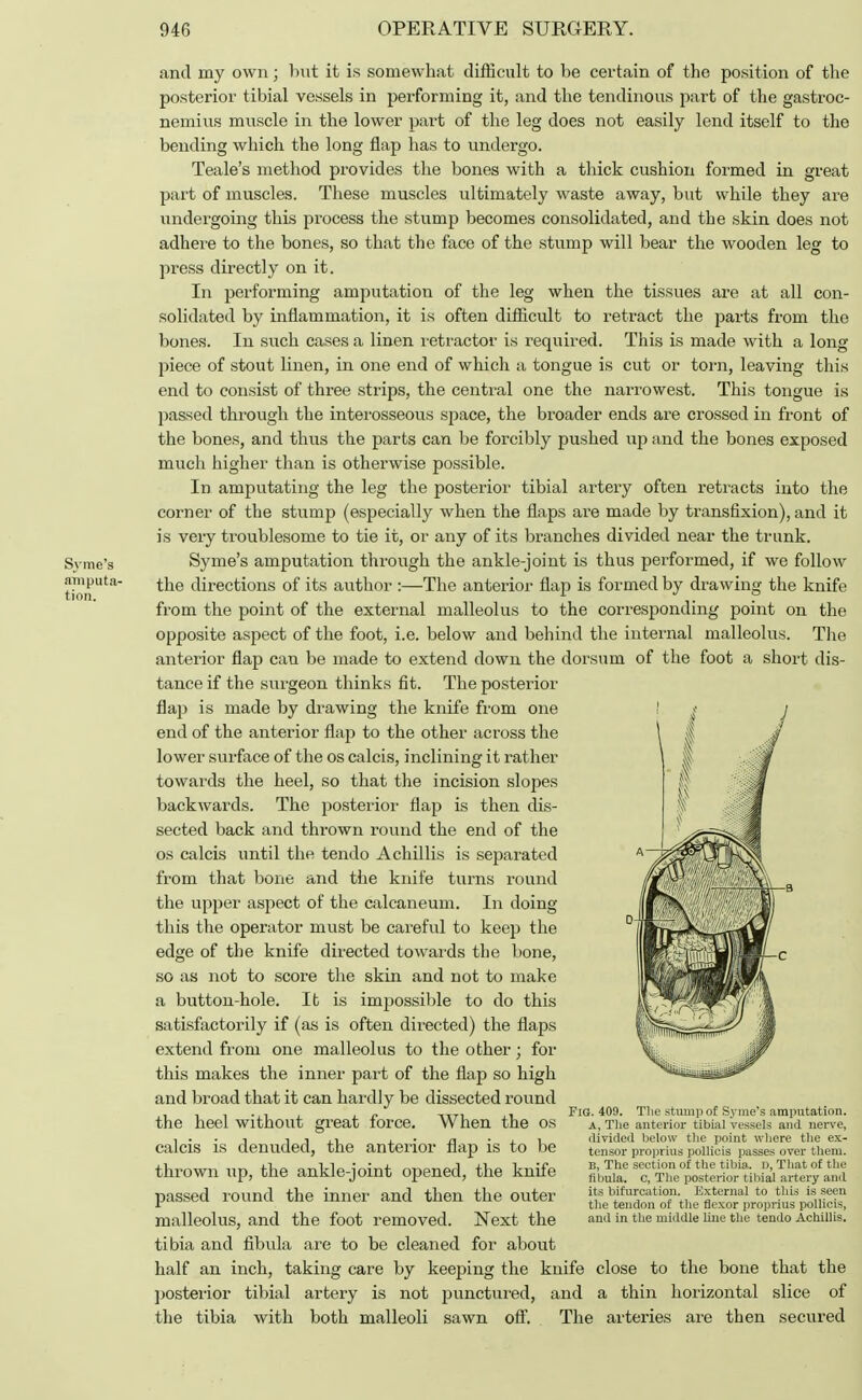 Syme's amputa- tion. and my own; but it is somewhat difficult to be certain of the position of the posterior tibial vessels in performing it, and the tendinous part of the gastroc- nemius muscle in the lower part of the leg does not easily lend itself to the bending which the long flap has to undergo. Teale's method provides the bones with a thick cushion formed in great part of muscles. These muscles ultimately waste away, but while they are undergoing this process the stump becomes consolidated, and the skin does not adhere to the bones, so that the face of the stump will bear the wooden leg to press directly on it. In performing amputation of the leg when the tissues are at all con- solidated by inflammation, it is often difficult to retract the parts from the bones. In such cases a linen retractor is required. This is made with a long piece of stout linen, in one end of which a tongue is cut or torn, leaving this end to consist of three strips, the central one the narrowest. This tongue is passed through the interosseous space, the broader ends are crossed in front of the bones, and thus the parts can be forcibly pushed up and the bones exposed much higher than is otherwise possible. In amputating the leg the posterior tibial artery often retracts into the corner of the stump (especially when the flaps are made by transfixion), and it is very troublesome to tie it, or any of its branches divided near the trunk. Syme's amputation through the ankle-joint is thus performed, if we follow the directions of its author :—The anterior flap is formed by drawing the knife from the point of the external malleolus to the corresponding point on the opposite aspect of the foot, i.e. below and behind the internal malleolus. The anterior flap can be made to extend down the dorsum of the foot a short dis- tance if the surgeon thinks fit. The posterior flap is made by drawing the knife from one end of the anterior flap to the other across the lower surface of the os calcis, inclining it rather towards the heel, so that the incision slopes backwards. The posterior flap is then dis- sected back and thrown round the end of the os calcis until the tendo Achillis is separated from that bone and the knife turns round the upper aspect of the calcaneum. In doing this the operator must be careful to keep the edge of the knife directed towards the bone, so as not to score the skin and not to make a button-hole. It is impossible to do this satisfactorily if (as is often directed) the flaps extend from one malleolus to the other; for this makes the inner part of the flap so high and broad that it can hardly be dissected round the heel without great force. When the os calcis is denuded, the anterior flap is to be thrown up, the ankle-joint opened, the knife passed round the inner and then the outer malleolus, and the foot removed. Next the tibia and fibula are to be cleaned for about half an inch, taking care by keejjing the knife close to the bone that the posterior tibial artery is not punctured, and a thin horizontal slice of the tibia with both malleoli sawn off. The arteries are then secured Fig. 409 The stump of Syme's amputation. A, The anterior tibial vessels and nerve, divided below the point where the ex- tensor proprius pollicis passes over them. B, The section of the tibia. i>, That ot the fibula, c, The posterior tibial artery and its bifurcation. External to this is seen the tendon of the flexor proprius pollicis, and in the middle line the tendo Achillis.