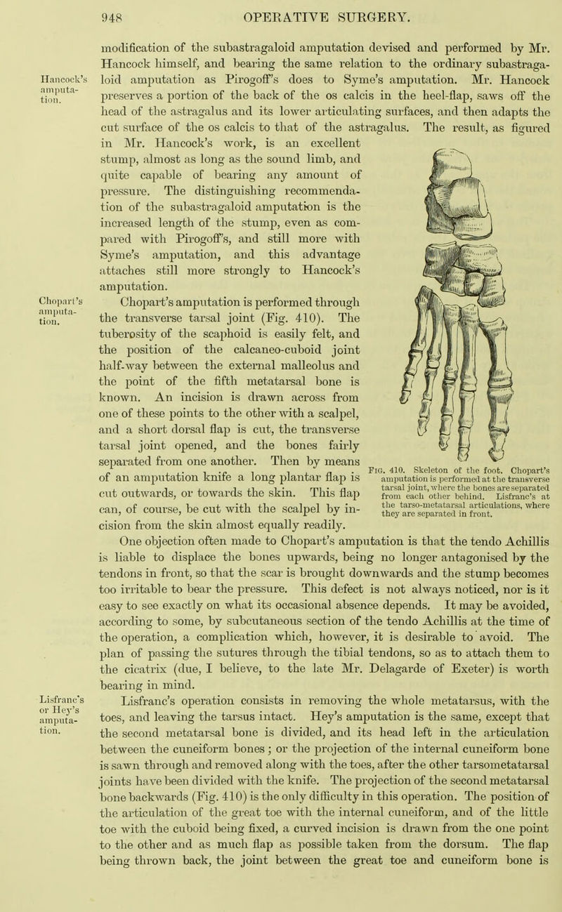Hancock's amputa- tion. Chopart's amputa- tion. Lisfrane's or I Ii'3-'s amputa- tion. modification of the subastragaloid amputation devised and performed by Mr. Hancock himself, and bearing the same relation to the ordinary subastraga- loid amputation as Pirogoff's does to Syme's amputation. Mr. Hancock preserves a portion of the back of the os calcis in the heel-flap, saws off the head of the astragalus and its lower articulating surfaces, and then adapts the cut surface of the os calcis to that of the astragalus. The result, as figured in Mr. Hancock's work, is an excellent stump, almost as long as the sound limb, and quite capable of bearing any amount of pressure. The distinguishing recommenda- tion of the subastragaloid amputation is the increased length of the stump, even as com- pared with Pirogoff's, and still more with Syme's amputation, and this advantage attaches still more strongly to Hancock's amputation. Chopart's amputation is performed through the transverse tarsal joint (Fig. 410). The tuberosity of the scaphoid is easily felt, and the position of the calcaneo-cuboid joint half-way between the external malleolus and the point of the fifth metatarsal bone is known. An incision is drawn across from one of these points to the other with a scalpel, and a short dorsal flap is cut, the transverse tarsal joint opened, and the bones fairly separated from one another. Then by means of an amputation knife a long plantar flap is cut outwards, or towards the skin. This flap can, of course, be cut with the scalpel by in- cision from the skin almost equally readily. One objection often made to Chopart's amputation is that the tendo Achillis is liable to displace the bones upwards, being no longer antagonised by the tendons in front, so that the scar is brought downwards and the stump becomes too irritable to bear the pressure. This defect is not always noticed, nor is it easy to see exactly on what its occasional absence depends. It may be avoided, according to some, by subcutaneous section of the tendo Achillis at the time of the operation, a complication which, however, it is desirable to avoid. The plan of passing the sutures through the tibial tendons, so as to attach them to the cicatrix (due, I believe, to the late Mr. Delagarde of Exeter) is worth bearing in mind. Lisfrane's operation consists in removing the whole metatarsus, with the toes, and leaving the tarsus intact. Hey's amputation is the same, except that the second metatarsal bone is divided, and its head left in the articulation between the cuneiform bones; or the projection of the internal cuneiform bone is sawn through and removed along with the toes, after the other tarsometatarsal joints have been divided with the knife. The projection of the second metatarsal bone backwards (Fig. 410) is the only difficulty in this operation. The position of the articulation of the great toe with the internal cuneiform, and of the little toe with the cuboid being fixed, a curved incision is drawn from the one point to the other and as much flap as possible taken from the dorsum. The flap being thrown back, the joint between the great toe and cuneiform bone is Fig. 410 Skeleton of the foot. Chopart's amputation is performed at the transverse tarsal joint, where the hones are separated from each other behind. Lisfrane's at the tarso-metatarsal articulations, where they are separated in front.