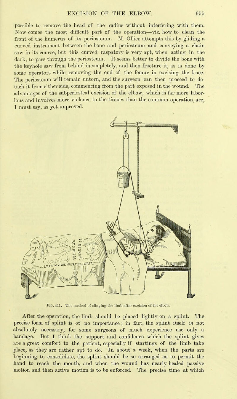 possible to remove the head of the radius without interfering with them. Now comes the most difficult part of the operation—viz. how to clean the front of the humerus of its periosteum. M. Oilier attempts this by gliding a curved instrument between the bone and periosteum and conveying a chain saw in its course, but this curved raspatory is very apt, when acting in the dark, to pass through the periosteum. It seems better to divide the bone with the keyhole saw from behind incompletely, and then fracture it, as is done by some operators while removing the end of the femur in excising the knee. The periosteum will remain untorn, and the surgeon can then proceed to de- tach it from either side, commencing from the part exposed in the wound. The advantages of the subperiosteal excision of the elbow, which is far more labor- ious and involves more violence to the tissues than the common operation, are, I must say, as yet unproved. Fig. 411. The method of slinging the limb after excision of the elbow. After the operation, the limb should be placed lightly on a splint. The precise form of splint is of no importance; in fact, the splint itself is not absolutely necessary, for some surgeons of much experience use only a bandage. But I think the support and confidence which the splint gives are a great comfort to the patient, especially if startings of the limb take place, as they are rather apt to do. In about a week, when the parts are beginning to consolidate, the splint should be so arranged as to permit the hand to reach the mouth, and when the wound has nearly healed passive motion and then active motion is to be enforced. The precise time at which