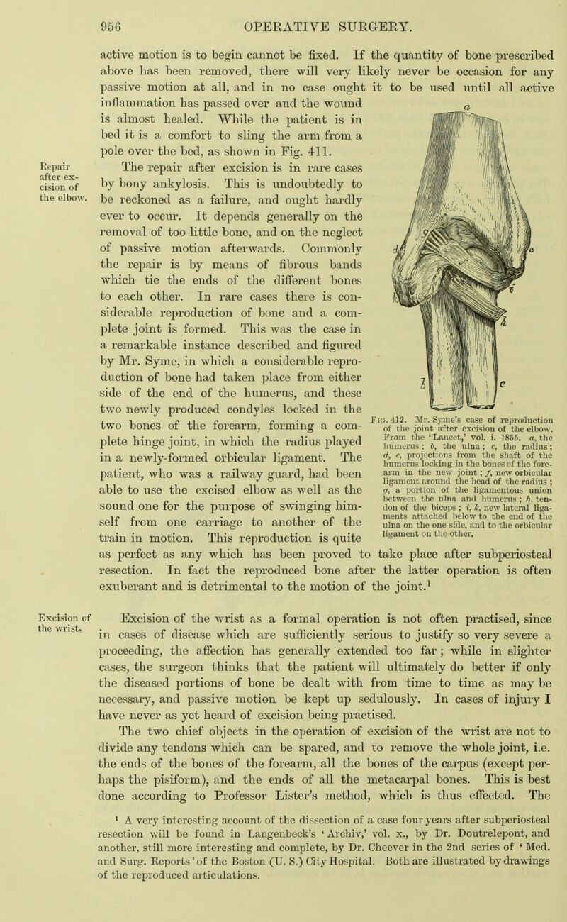 Repair after ex- cision of the elbow. active motion is to begin cannot be fixed. If the quantity of bone prescribed above has been removed, there will very likely never be occasion for any passive motion at all, and in no case ought it to be used until all active inflammation has passed over and the wound is almost healed. While the patient is in bed it is a comfort to sling the arm from a pole over the bed, as shown in Fig. 411. The repair after excision is in rare cases by bony ankylosis. This is undoubtedly to be reckoned as a failure, and ought hardly ever to occur. It depends generally on the removal of too little bone, and on the neglect of passive motion afterwards. Commonly the repair is by means of fibrous bands which tie the ends of the different bones to each other. In rare cases there is con- siderable reproduction of bone and a com- plete joint is formed. This was the case in a remarkable instance described and figured by Mr. Syme, in which a considerable repro- duction of bone had taken place from either side of the end of the humerus, and these two newly produced condyles locked in the two bones of the forearm, forming a com- plete hinge joint, in which the radius played in a newly-formed orbicular ligament. The patient, who was a railway guard, had been able to use the excised elbow as well as the sound one for the purpose of swinging him- self from one carriage to another of the train in motion. This reproduction is quite as perfect as any which has been proved to take place after subperiosteal resection. In fact the reproduced bone after the latter operation is often exuberant and is detrimental to the motion of the joint.1 Fig. 412. Mr. Syine's case of reproduction of the joint after excision of the elbow. From the ' Lancet,' vol. i. 1855. a, the humerus ; b, the ulna; c, the radius; d, e, projections from the shaft of the humerus locking in the bones of the fore- arm in the new joint; /, new orbicular ligament around the head of the radius ; g, a portion of the ligamentous union between the ulna and humerus ; ft, ten- don of the biceps ; i, k, new lateral liga- ments attached below to the end of the ulna on the one side, and to the orbicular ligament on the other. Excision of Excision of the wrist as a formal operation is not often practised, since e wns .. «n cases 0f disease which are sufficiently serious to justify so very severe a proceeding, the affection has generally extended too far; while in slighter cases, the surgeon thinks that the patient will ultimately do better if only the diseased portions of bone be dealt with from time to time as may be necessary, and passive motion be kept up sedulously. In cases of injury I have never as yet heard of excision being practised. The two chief objects in the operation of excision of the wrist are not to divide any tendons which can be spared, and to remove the whole joint, i.e. the ends of the bones of the forearm, all the bones of the carpus (except per- haps the pisiform), and the ends of all the metacarpal bones. This is best done according to Professor Lister's method, which is thus effected. The 1 A very interesting account of the dissection of a case four years after subperiosteal resection will be found in Langenbeck's ' Archiv,' vol. x., by Dr. Doutrelepont, and another, still more interesting and complete, by Dr. Clieever in the 2nd series of ' Med. and Surg. Reports 'of the Boston (U. S.) City Hospital. Both are illustrated by drawings of the reproduced articulations.