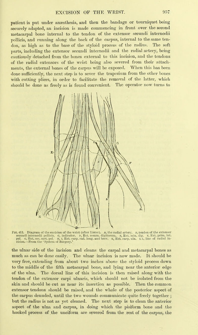 patient is put under anaesthesia, and then the bandage or tourniquet being securely adapted, an incision is made commencing in front over the second metacarpal bone internal to the tendon of the extensor secundi internodii pollicis, and running along the back of the carpus, internal to the same ten- don, as high as to the base of the styloid process of the radius. The soft parts, including the extensor secundi internodii and the radial artery, being cautiously detached from the bones external to this incision, and the tendons of the radial extensors of the wrist being also severed from their attach- ments, the external bones of the carpus will be exposed. When this has been done sufficiently, the next step is to sever the trapezium from the other bones with cutting pliers, in order to facilitate the removal of the latter, which should be done as freely as is found convenient. The operator now turns to Fig. 413. Diagram of the excision of the wrist (after Lister). A, the radial artery, b, tendon of the extensor secundi internodii pollicis. c, indicator, d, Ext. comm. digitoraru. B, Ext. min. dig. F, Ext. prim. int. pol. G, Ext. oss. met. pol. H, I, Ext. carp. rad. long, and brev. K, Ext. carp. uln. L L, line of radial in- cision.—From the ' System of Surgery.' the ulnar side of tbe incision and cleans the carpal and metacarpal bones as much as can be done easily. The ulnar incision is now made. It should be very free, extending from about two inches above the styloid process down to the middle of the fifth metacarpal bone, and lying near the anterior edge of the ulna. The dorsal line of this incision is then raised along with the tendon of the extensor carpi ulnaris, which should not be isolated from the skin and should be cut as near its insertion as possible. Then the common extensor tendons should be raised, and the whole of the posterior aspect of the carpus denuded, until the two wounds communicate quite freely together ; but the radius is not as yet cleaned. The next step is to clean the anterior aspect of the ulna and carpus, in doing which the pisiform bone and the hooked process of the unciform are severed from the rest of the carpus, the