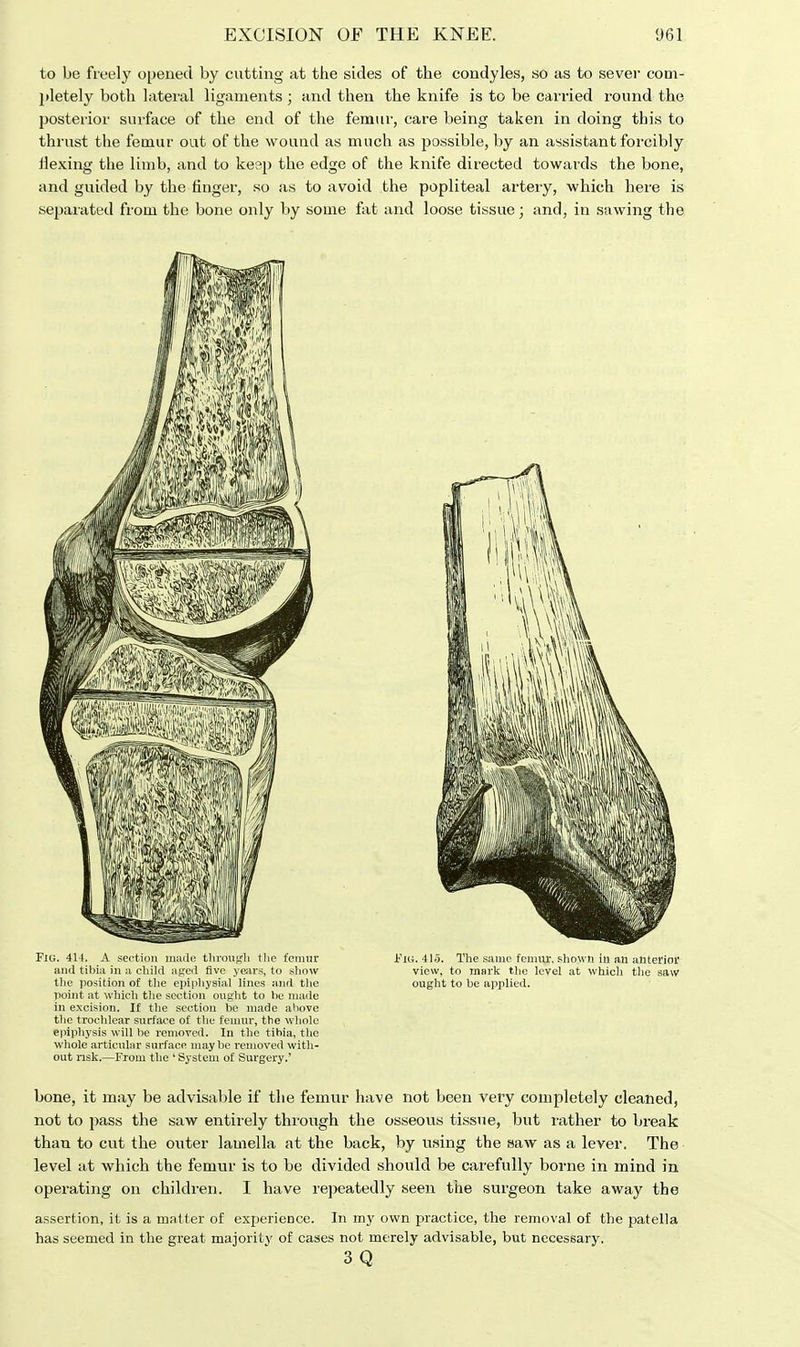 to be freely opened by cutting at the sides of the condyles, so as to sever com- pletely both lateral ligaments ; and then the knife is to be carried round the posterior surface of the end of the femur, care being taken in doing this to thrust the femur out of the wound as much as possible, by an assistant forcibly Hexing the limb, and to keep the edge of the knife directed towards the bone, and guided by the finger, so as to avoid the popliteal artery, which here is separated from the bone only by some fat and loose tissue; and, in sawing the Fig. 414. A section made through the femur and tibia in a child aged five years, to show the position of the epiphysial lines and the point at which the seetion ought to be made in excision. If the section be made above tiie trochlear surface of the femur, the whole epiphysis will be removed. In the tibia, the whole articular surface maybe removed with- out risk.—From the ' System of Surgery.' Fig. 41o. The same femur, shown in an anterior view, to mark the level at which the saw ought to be applied. bone, it may be advisable if the femur have not been very completely cleaned, not to pass the saw entirely through the osseous tissue, but rather to break than to cut the outer lamella at the back, by using the saw as a lever. The level at which the femur is to be divided should be carefully borne in mind in operating on children. I have repeatedly seen the surgeon take away the assertion, it is a matter of experience. In my own practice, the removal of the patella has seemed in the great majority of cases not merely advisable, but necessary. 3 Q