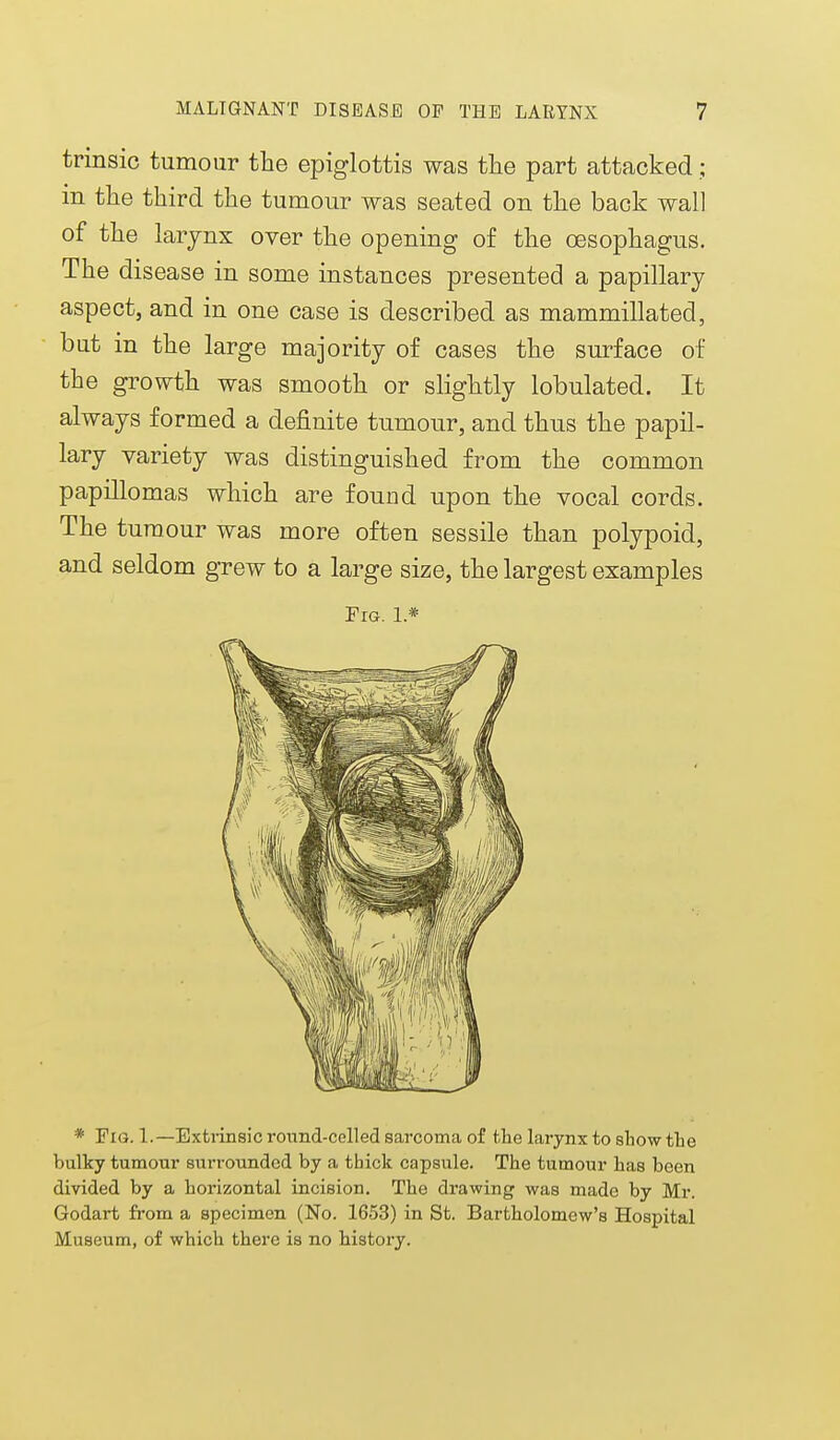 trinsic tumour the epiglottis was the part attacked; in the third the tumour was seated on the back wall of the larjnx over the opening of the oesophagus. The disease in some instances presented a papillary aspect, and in one case is described as mammillated, but in the large majority of cases the surface of the growth was smooth or slightly lobulated. It always formed a definite tumour, and thus the papil- lary variety was distinguished from the common papillomas which are found upon the vocal cords. The tumour was more often sessile than polypoid, and seldom grew to a large size, the largest examples Fig. 1 * * Fig. 1.—Extrinsic round-celled sarcoma of the larynx to show the bulky tumour suri-oundcd by a thick capsule. The tumour has been divided by a horizontal incision. The drawing was made by Mr. Godart from a specimen (No. 1653) in St. Bartholomew's Hospital Museum, of which there is no history.