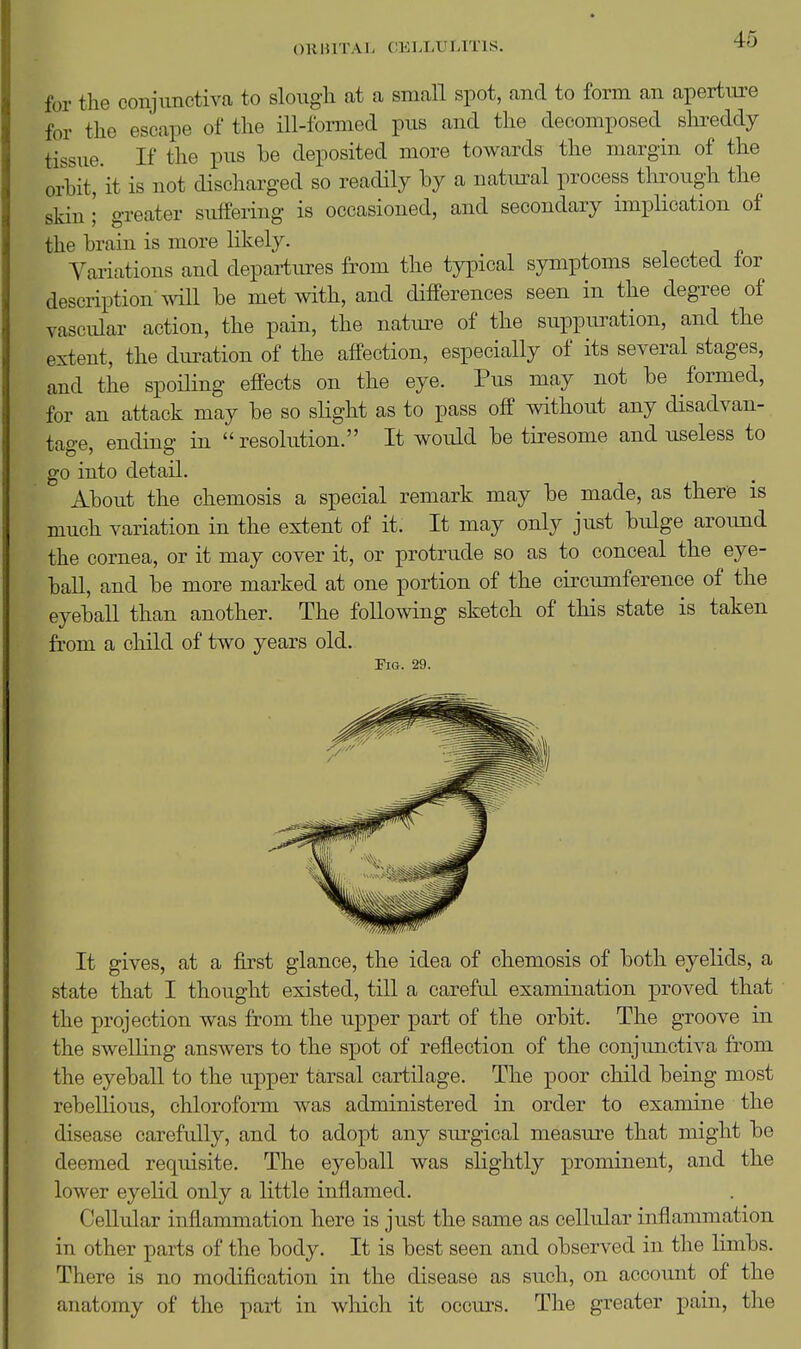 4o for the conjunctiva to slough at a small spot, and to form an aperture for the escape of the ill-formed pus and the decomposed shreddy tissue. If the pus be deposited more towards the margin of the orbit, it is not discharged so readily by a natural process through the skin • greater sulfering is occasioned, and secondary implication of the brain is more likely. i , i n Variations and depai-tures from the typical symptoms selected lor description'will be met with, and differences seen in the degree of vascidar action, the pain, the natm^e of the siippuration, and the extent, the duration of the affection, especially of its several stages, and the spoiling effects on the eye. Pus may not be formed, for an attack may be so slight as to pass off without any disadvan- tage, ending in  resolution. It would be tiresome and useless to go into detail. About the chemosis a special remark may be made, as there is much variation in the extent of it. It may only just bulge aroimd the cornea, or it may cover it, or protrude so as to conceal the eye- ball, and be more marked at one portion of the circumference of the eyeball than another. The following sketch of this state is taken from a cliild of two years old. Pig. 29. It gives, at a first glance, the idea of chemosis of both eyelids, a state that I thought existed, till a careful examination proved that the projection was from the upper part of the orbit. The groove in the swelling answers to the spot of reflection of the conjunctiva from the eyeball to the upper tarsal cartilage. The poor child being most rebellious, chloroform was administered in order to examine the disease carefully, and to adopt any surgical measure that might be deemed requisite. The eyeball was slightly prominent, and the lower eyelid only a little inflamed. Cellular inflammation here is just the same as cellular inflammation in other parts of the body. It is best seen and observed in the limbs. There is no modification in the disease as such, on account of the anatomy of the part in which it occurs. The greater pain, the