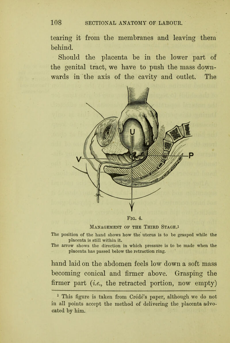 tearing it from the membranes and leaving them behind. Should the placenta be in the lower part of the genital tract, we have to push the mass down- wards in the axis of the cavity and outlet. The Fig. 4. Management of the Third Stage.1 The position of the hand shows how the uterus is to be grasped while the placenta is still within it. The arrow shows the direction in which pressure is to be made when the placenta has passed below the retraction ring. hand laid on the abdomen feels low down a soft mass becoming conical and firmer above. Grasping the firmer part {i.e., the retracted portion, now empty) ^ This figure is taken from Crede's paper, although we do not in all points accept the method of delivering the placenta advo- cated by him.