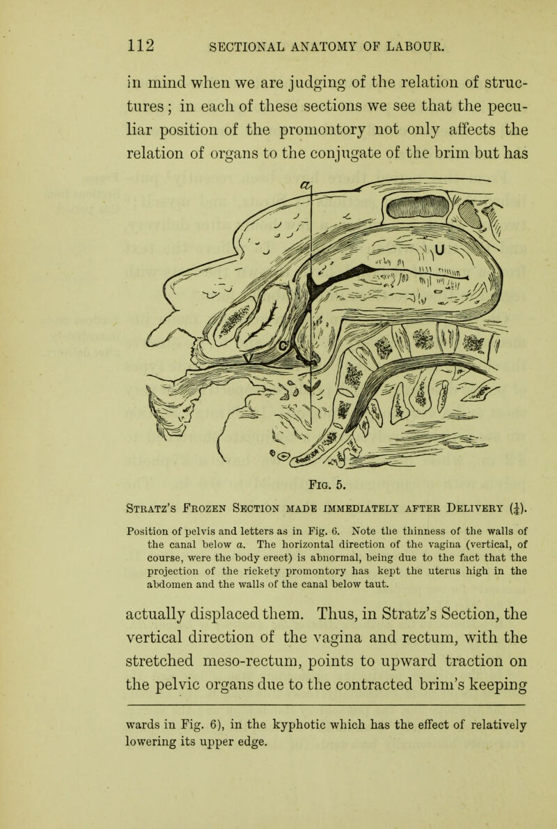 in mind when we are judging of the relation of struc- tures ; in each of these sections we see that tlie pecu- liar position of the promontory not only affects the relation of organs to the conjugate of the brim but has Fia. 5. Stratz's Frozen Section made immediately after Delivery (|). Position of pelvis and letters as in Fig. 6. Note the thinness of the walls of the canal below a. The horizontal direction of the vagina (vertical, of course, were the body erect) is abnormal, being due to the fact that the projection of the rickety promontory has kept the uterus high in the abdomen and the walls of the canal below taut. actually displaced them. Thus, in Stratz's Section, the vertical direction of the vagina and rectum, with the stretched meso-rectum, points to upward traction on the pelvic organs due to the contracted brim's keeping wards in Fig. 6), in the kyphotic which has the effect of relatively- lowering its upper edge.